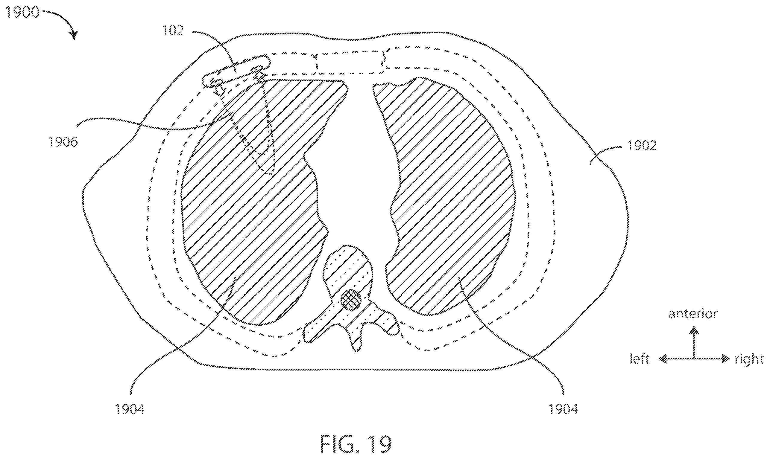 Patent US12599321 Figure 12 – Devices and methods for assessing pulmonary status using optical oxygenation sensing
