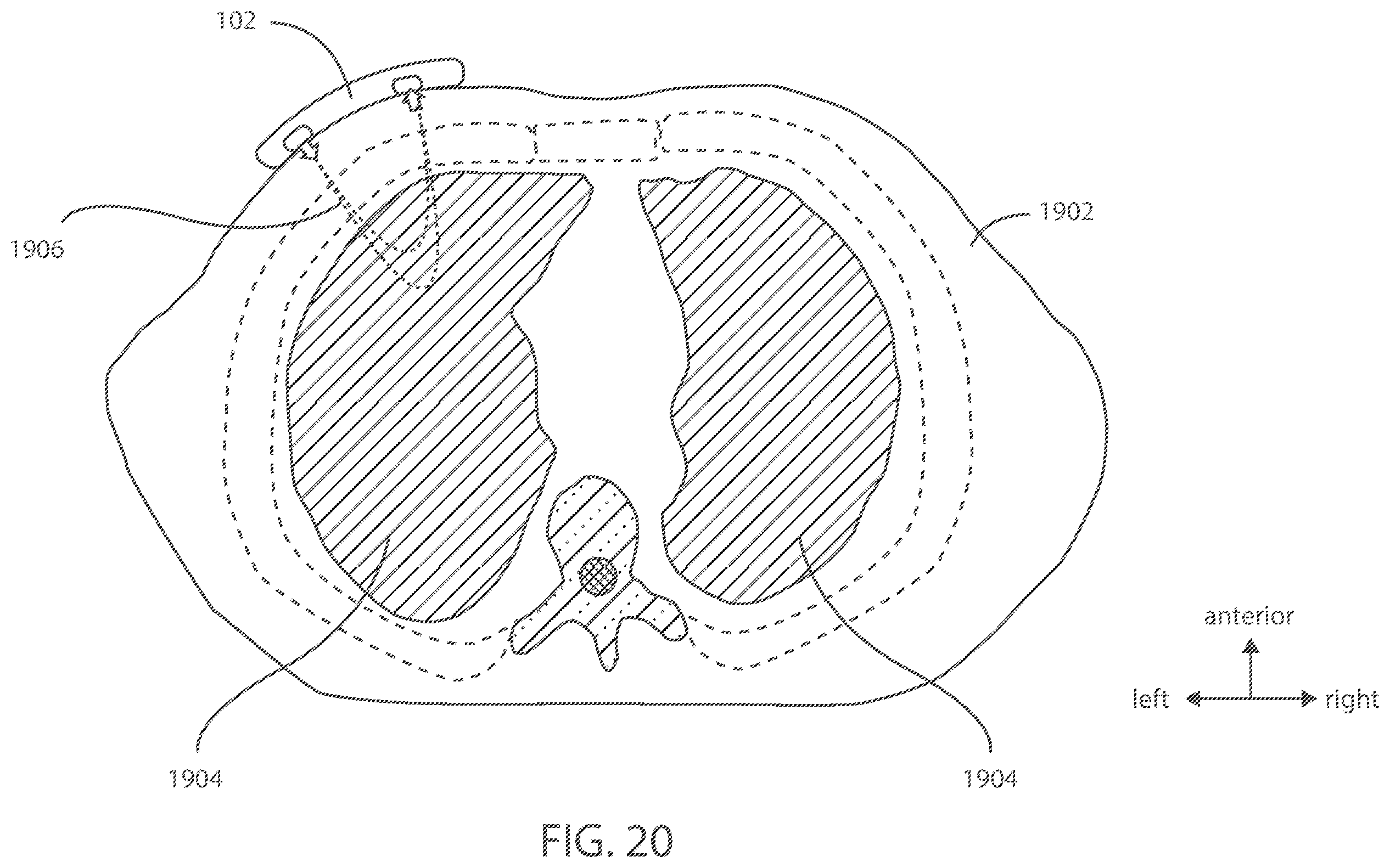 Patent US12599321 Figure 13 – Devices and methods for assessing pulmonary status using optical oxygenation sensing