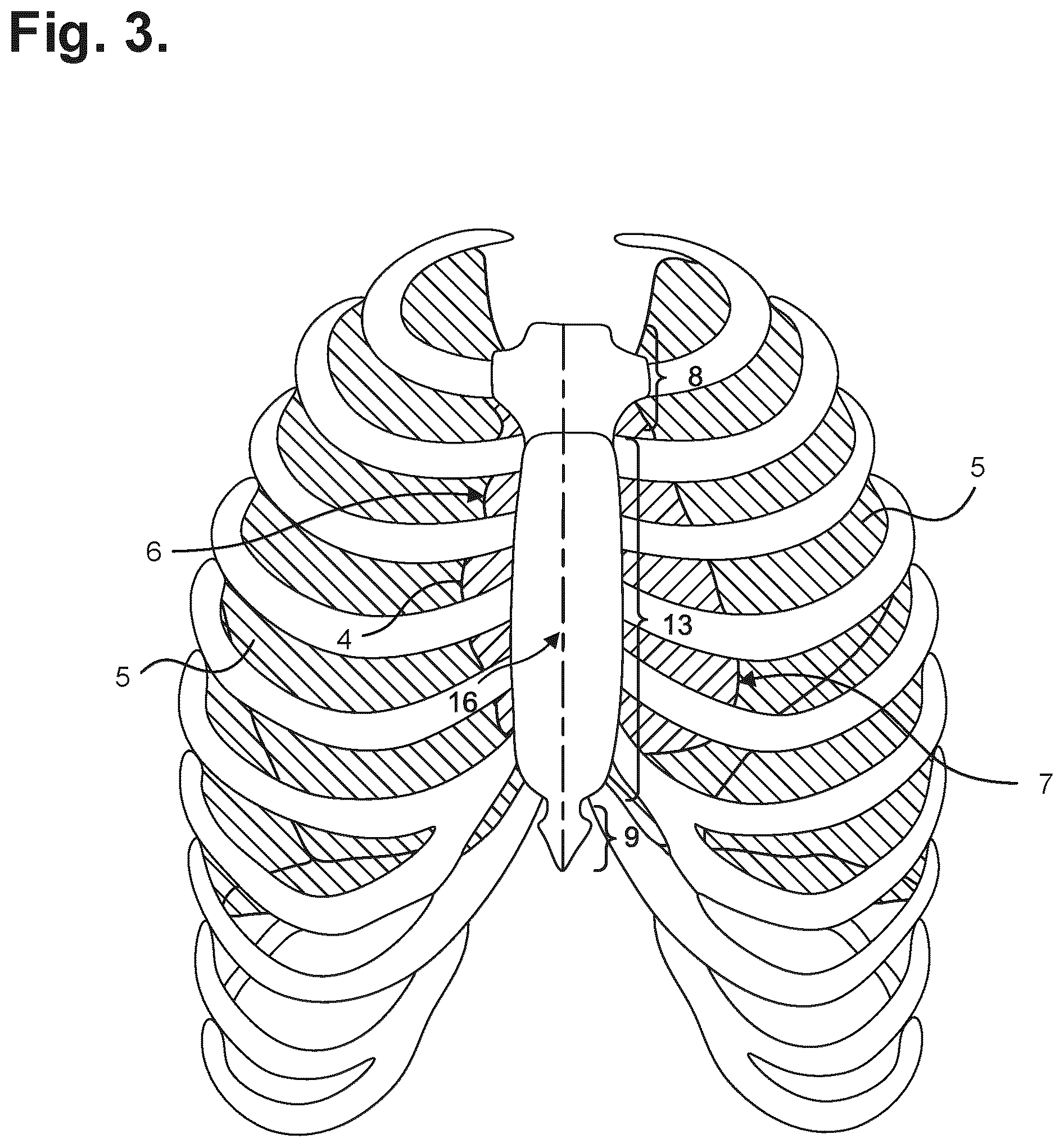 Patent US12599326 Figure 2 – Moisture-resistant electrocardiography monitor