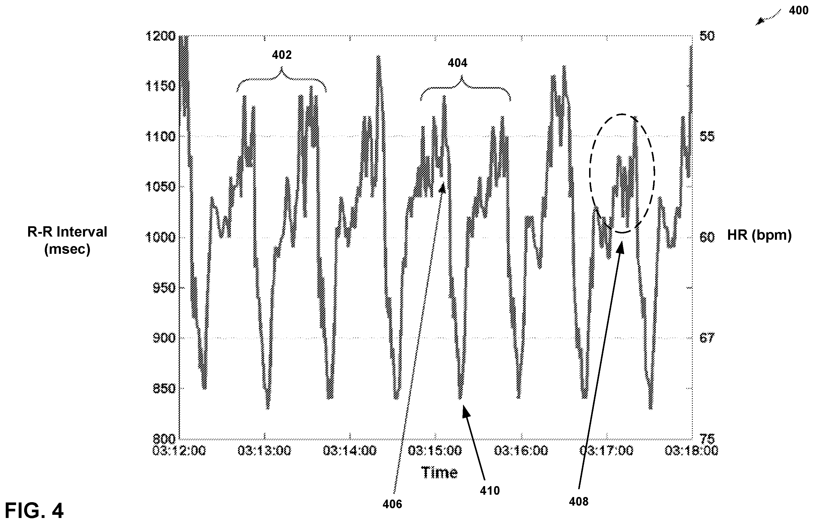 Patent US12599335 Figure 4 – Detection and monitoring of sleep apnea conditions