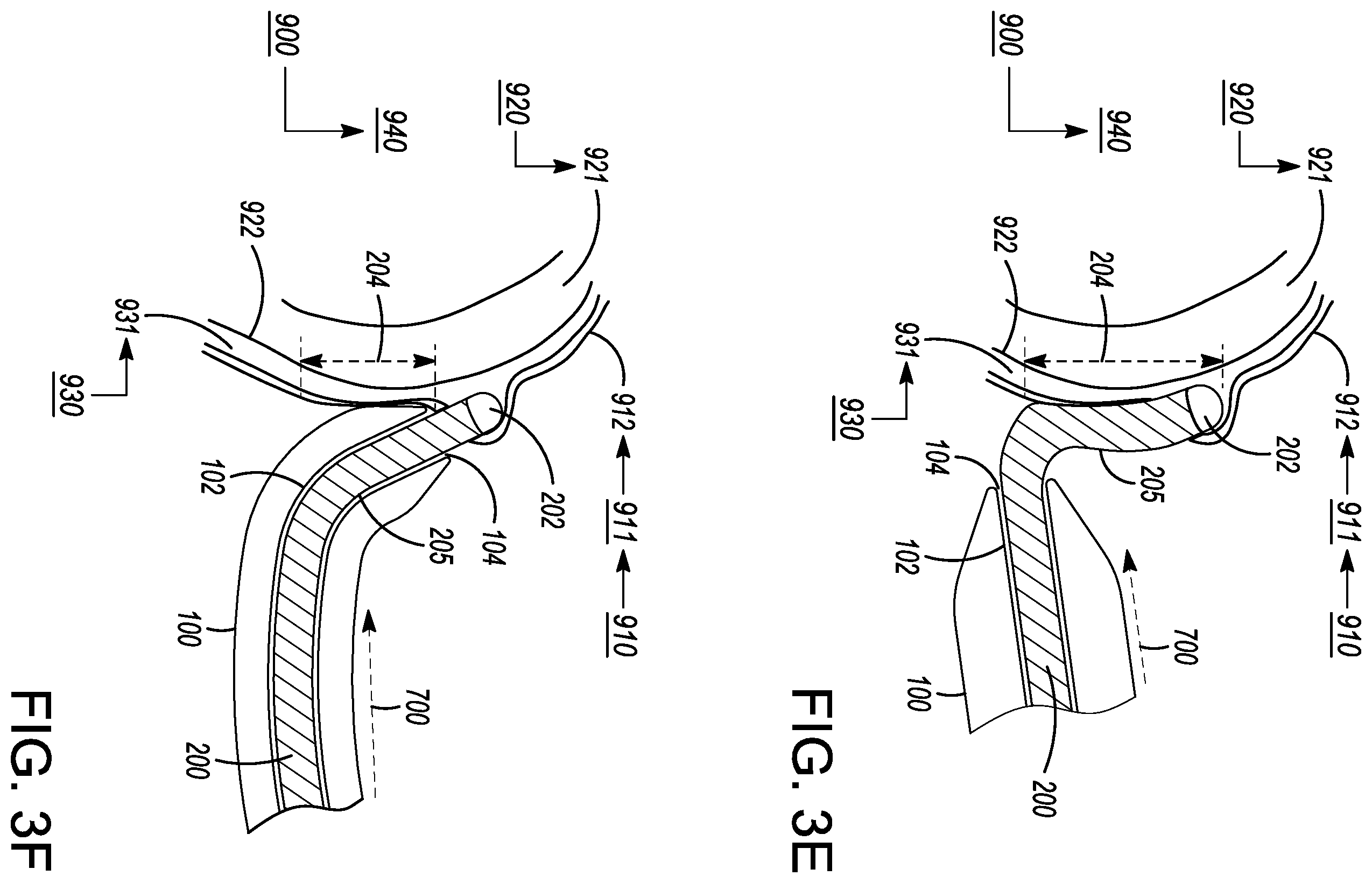 Patent US12599338 Figure 5 – Deflectable elongated guidewire assembly