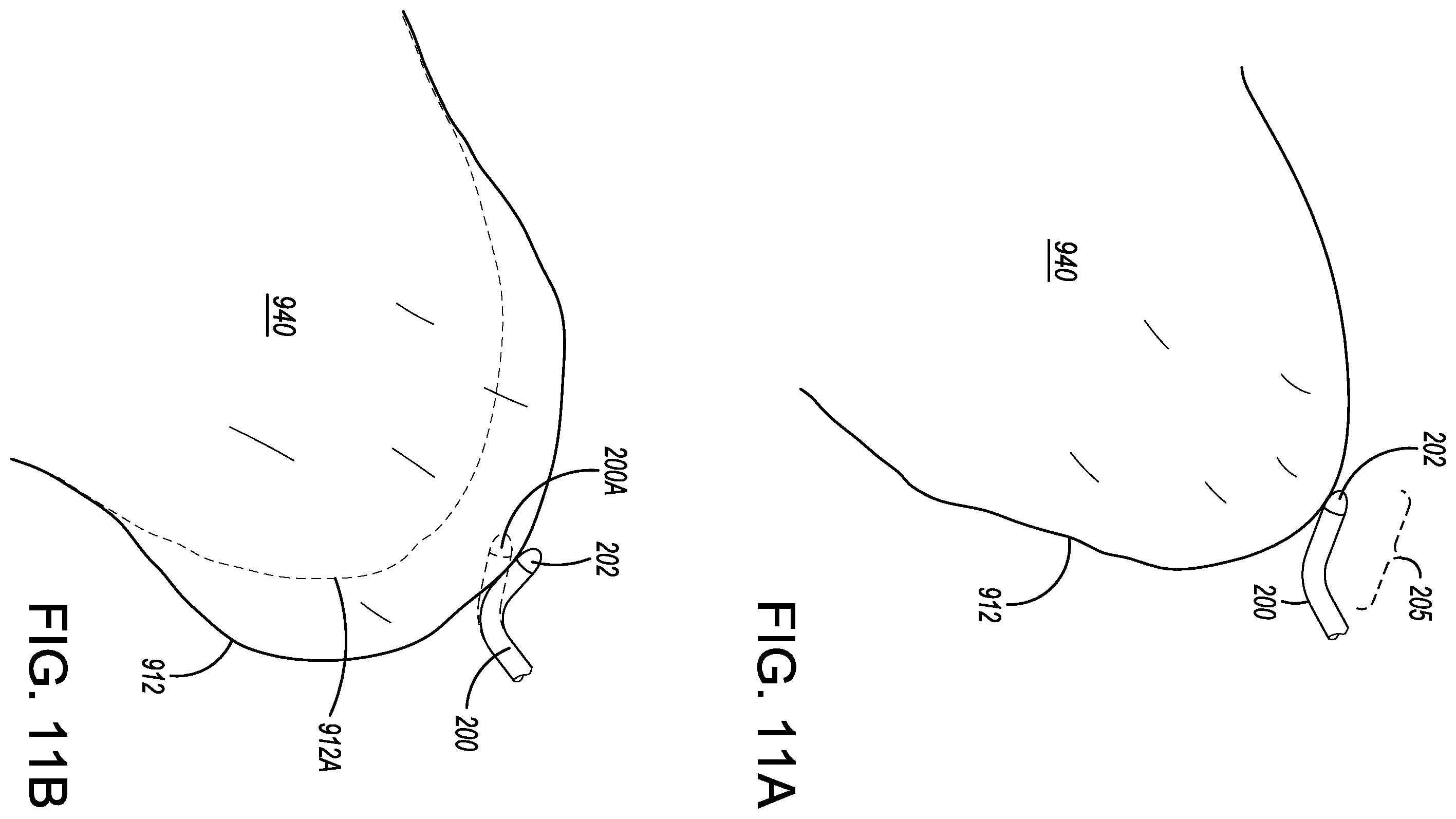 Patent US12599338 Figure 14 – Deflectable elongated guidewire assembly