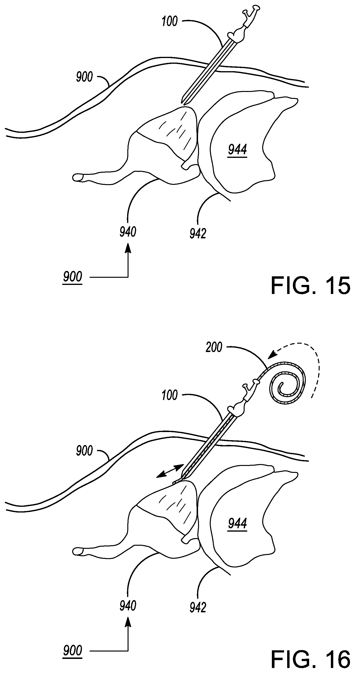 Patent US12599338 Figure 17 – Deflectable elongated guidewire assembly