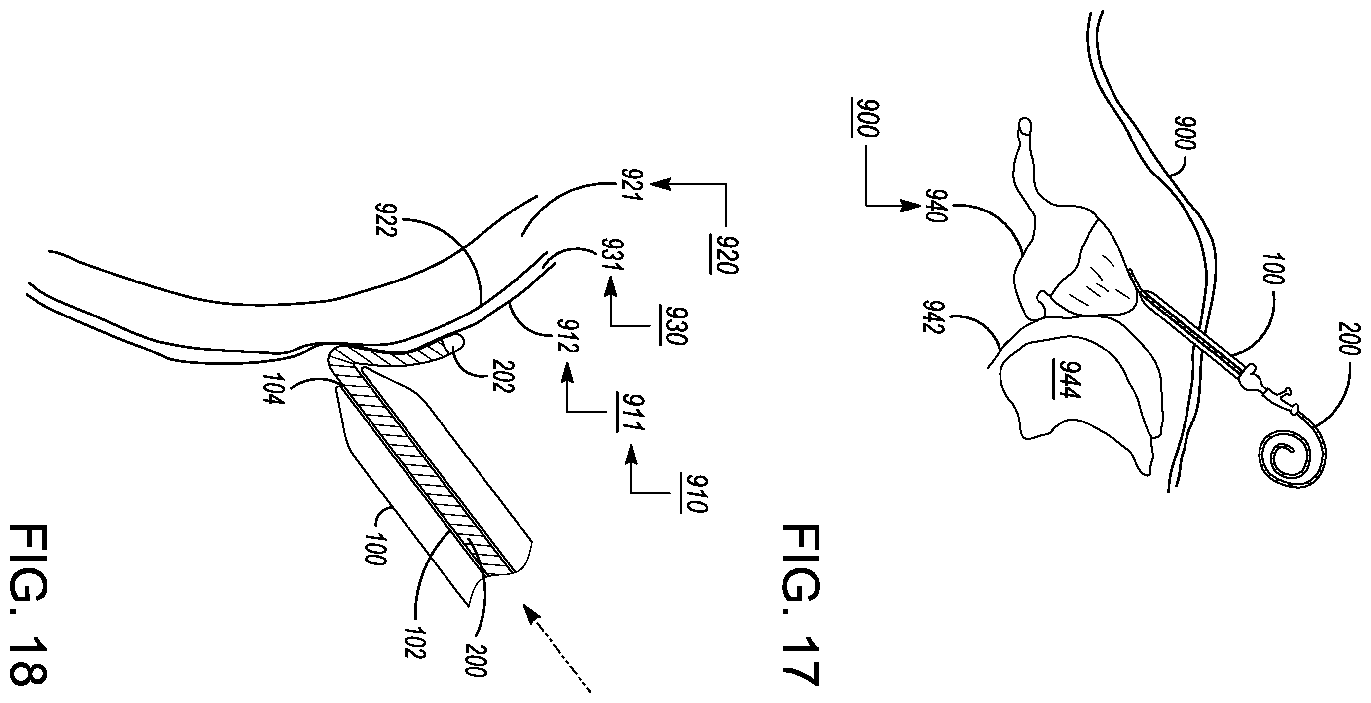 Patent US12599338 Figure 18 – Deflectable elongated guidewire assembly