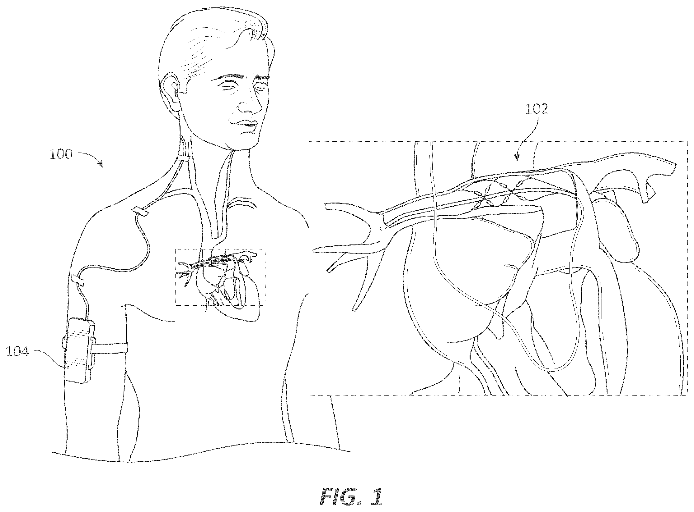 Patent US12599339 Figure 1 – Systems and methods for affecting cardiac contractility and/or relaxation