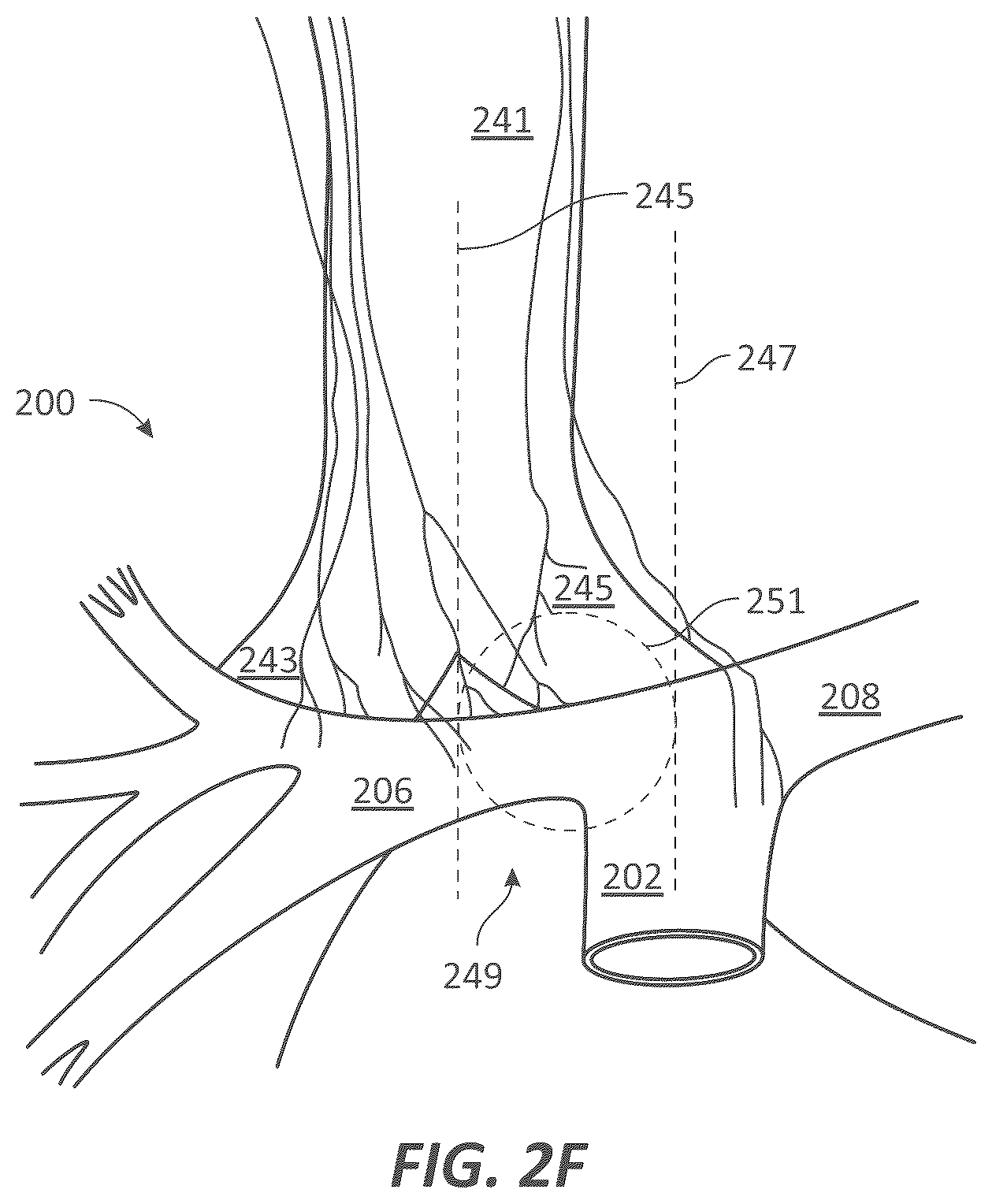 Patent US12599339 Figure 5 – Systems and methods for affecting cardiac contractility and/or relaxation
