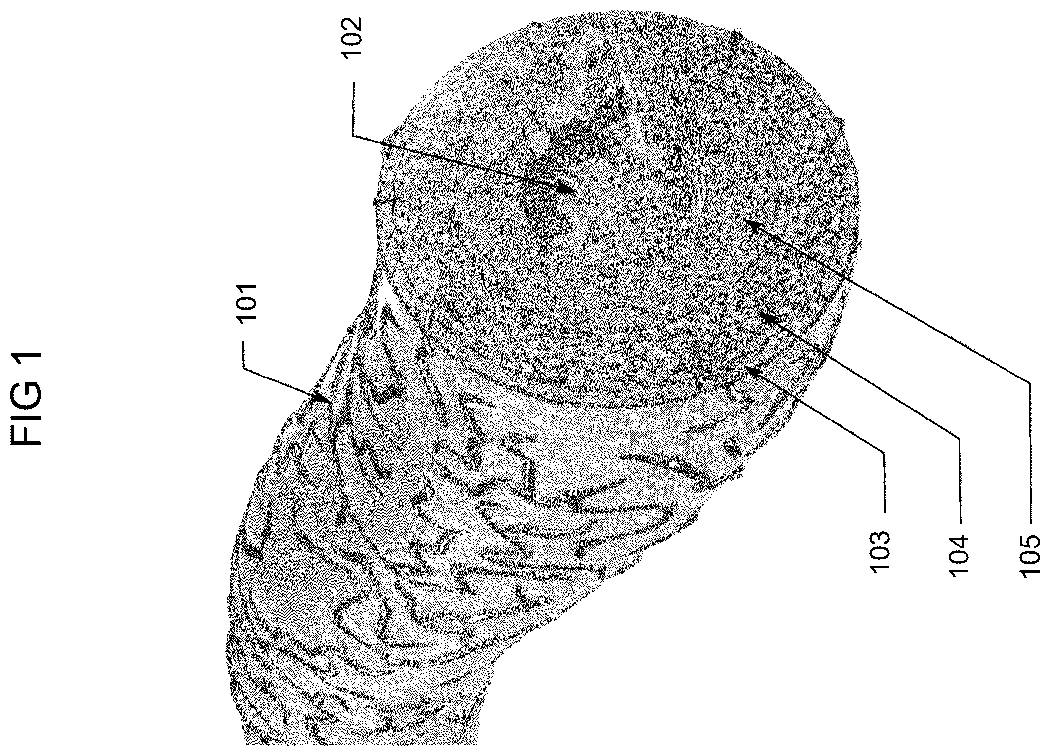 Patent US12599350 Figure 1 – Computed tomography based imaging of vasa vasorum density for detection and monitoring of inflammation and angiogenesis in vascular wall