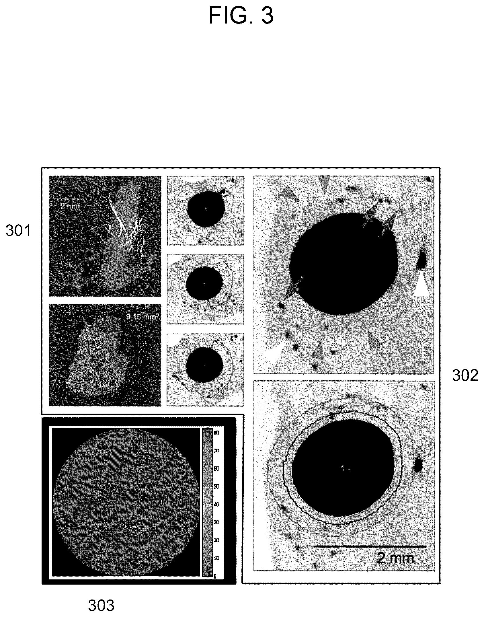 Patent US12599350 Figure 3 – Computed tomography based imaging of vasa vasorum density for detection and monitoring of inflammation and angiogenesis in vascular wall
