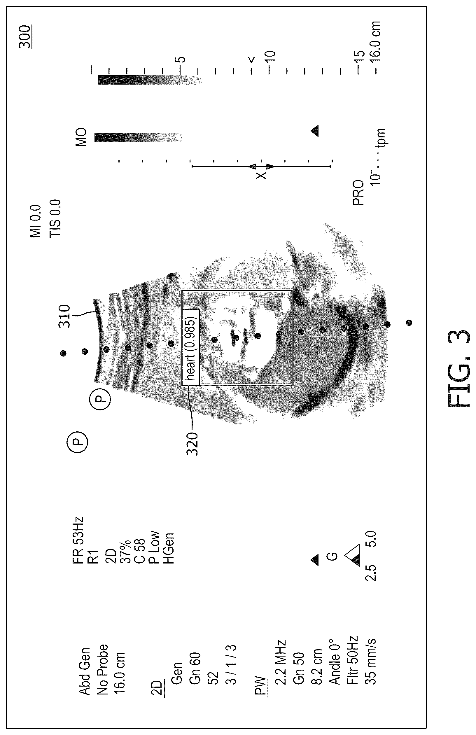 Patent US12599356 Figure 3 – Fetal heart rate monitoring