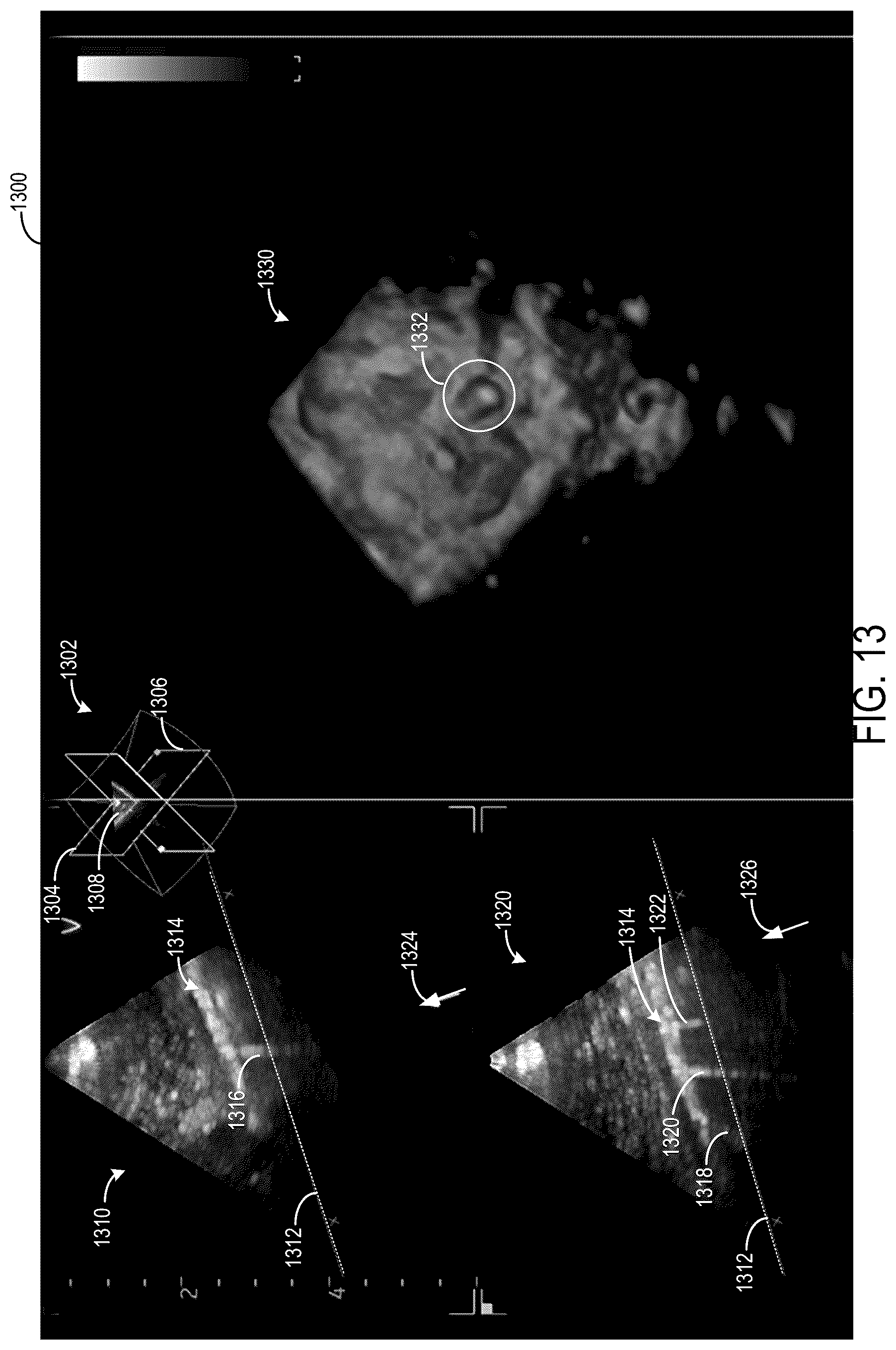 Patent US12599367 Figure 13 – Methods and systems for generating 3D pleural surfaces