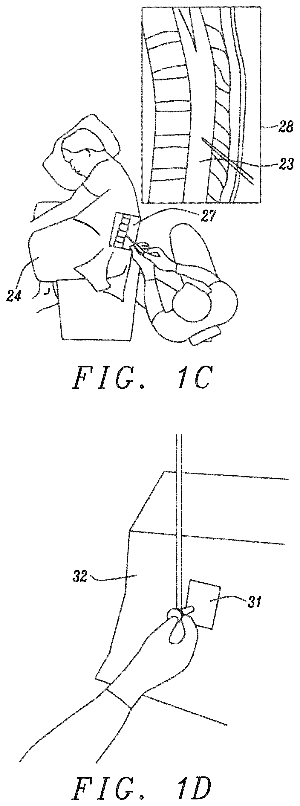 Patent US12599372 Figure 2 – Lumbar puncture locator device