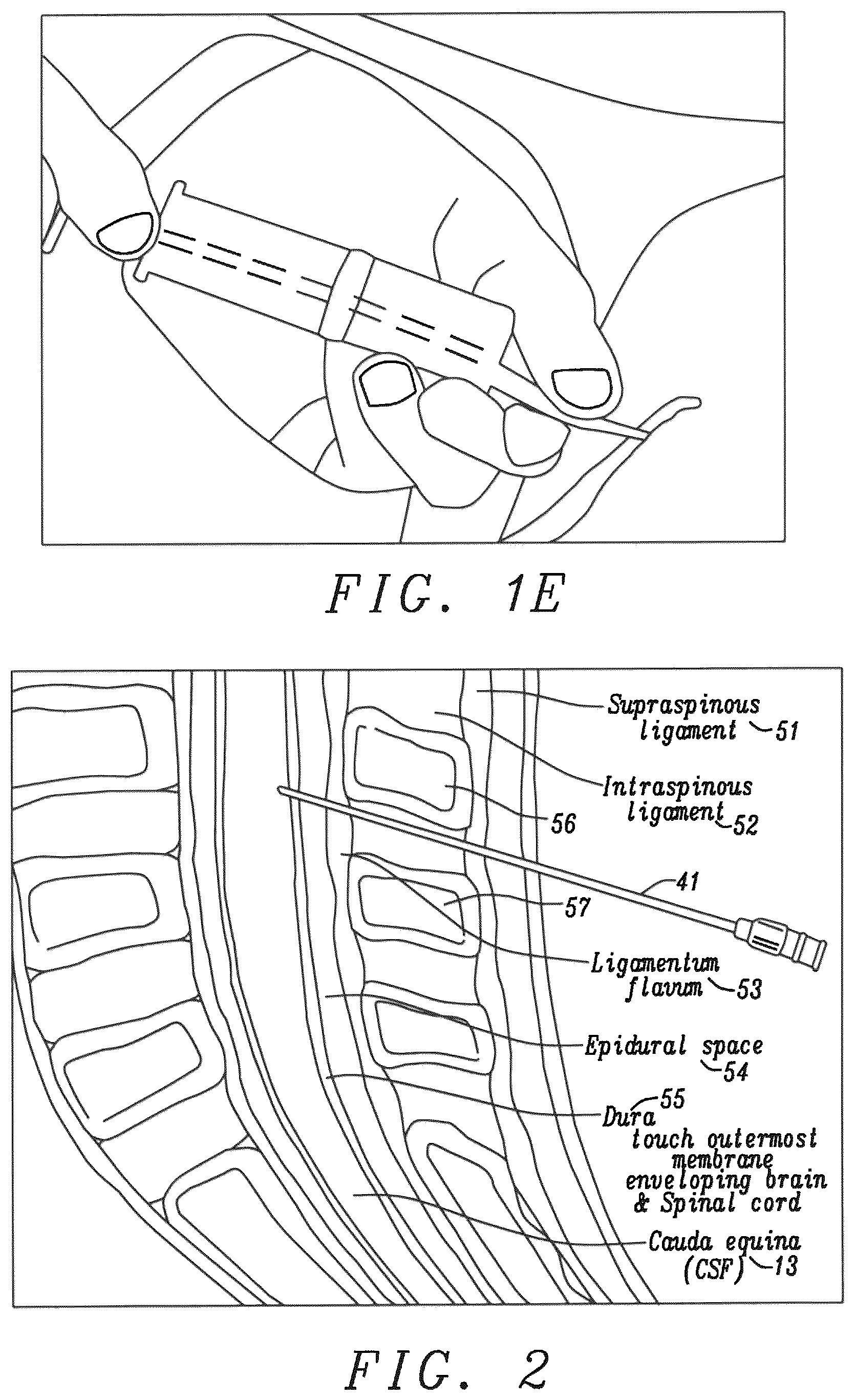Patent US12599372 Figure 3 – Lumbar puncture locator device