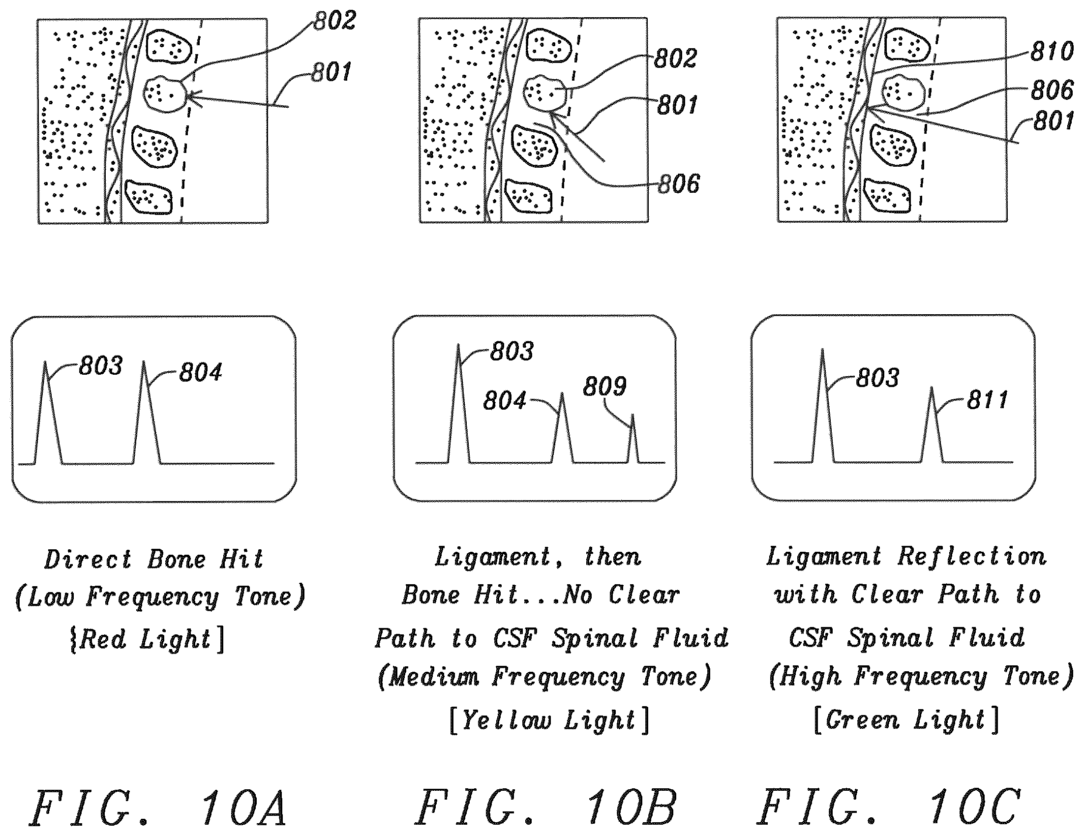 Patent US12599372 Figure 8 – Lumbar puncture locator device