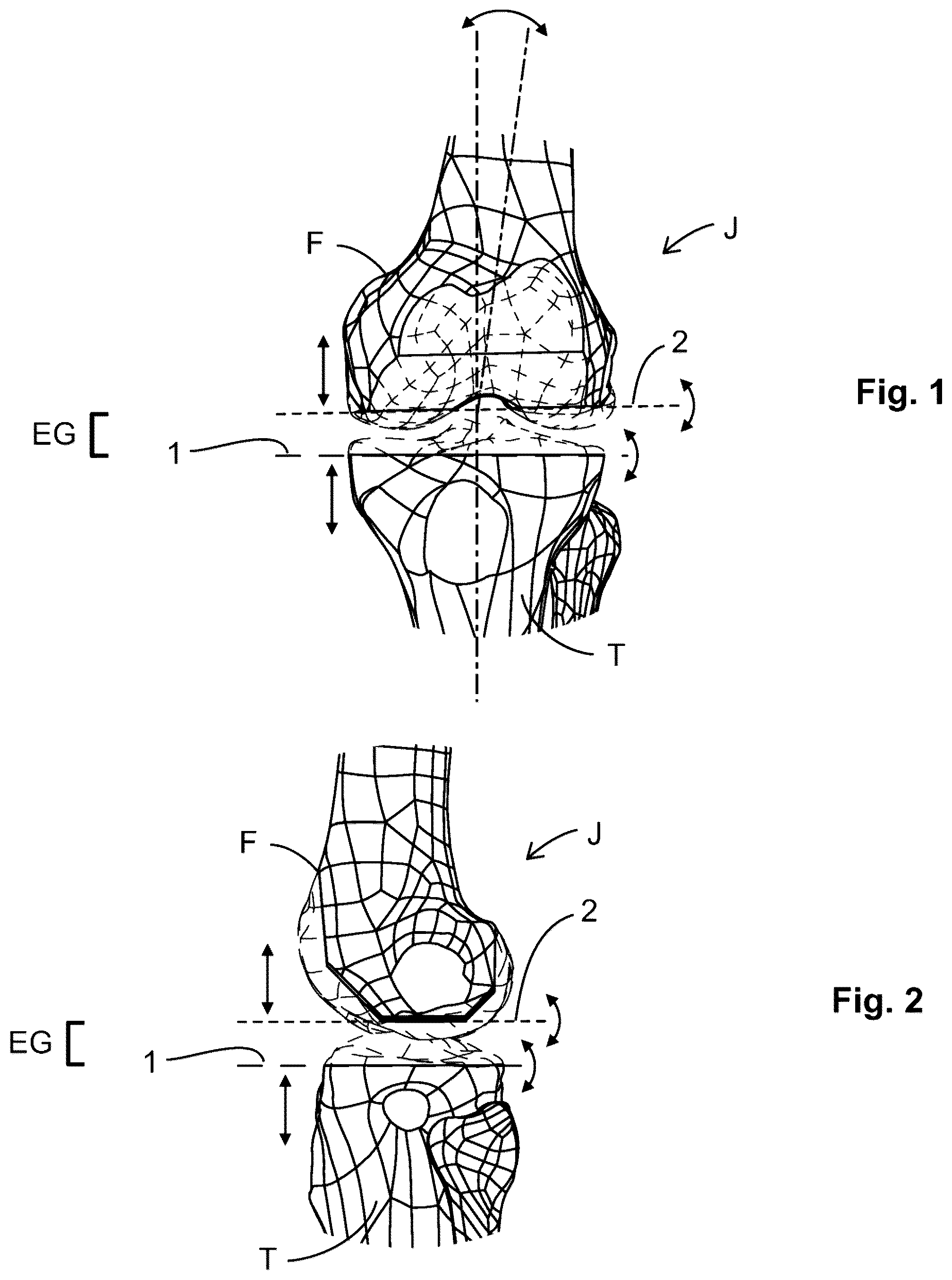 Patent US12599377 Figure 1 – Knee tensioner-balancer and method