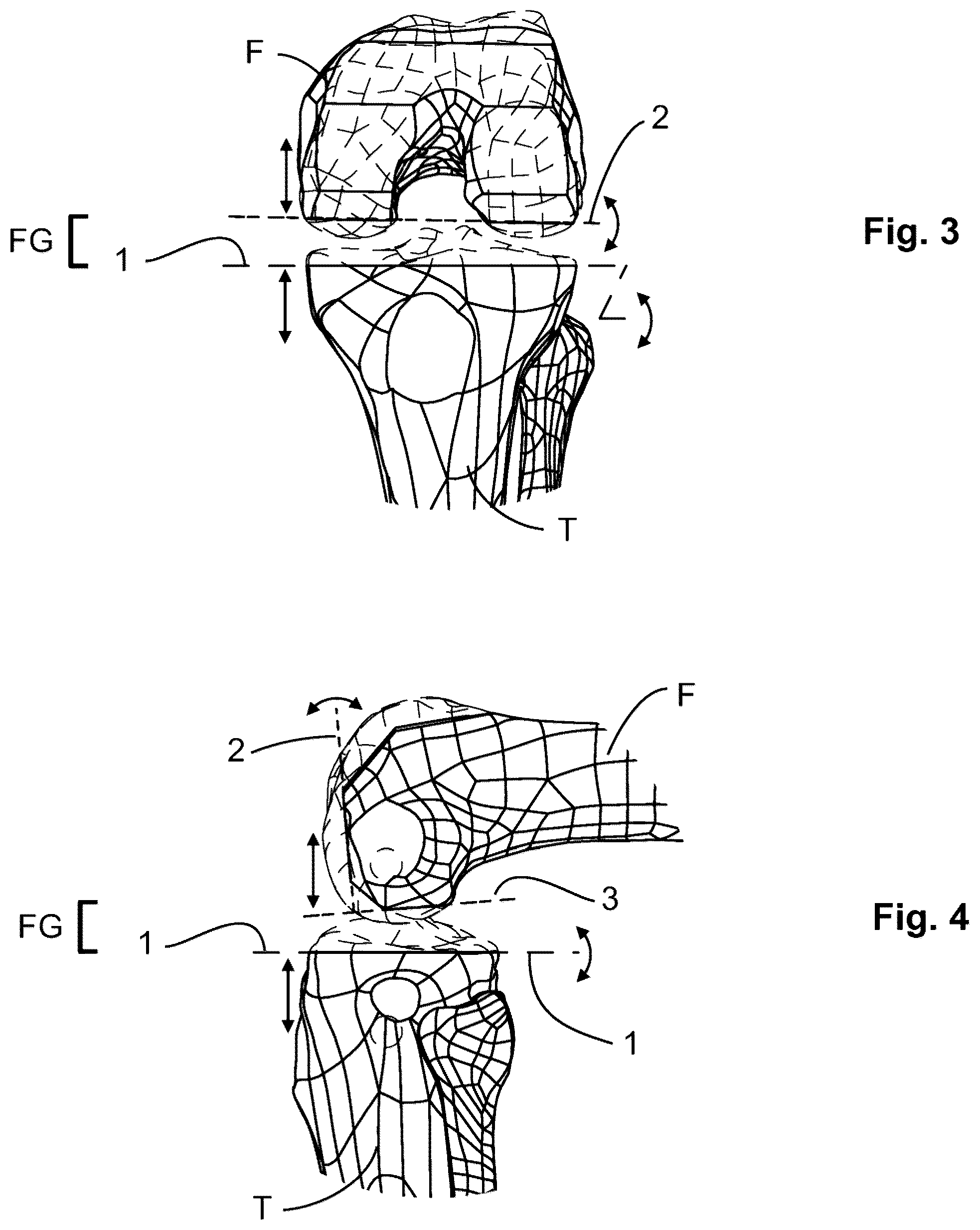 Patent US12599377 Figure 2 – Knee tensioner-balancer and method