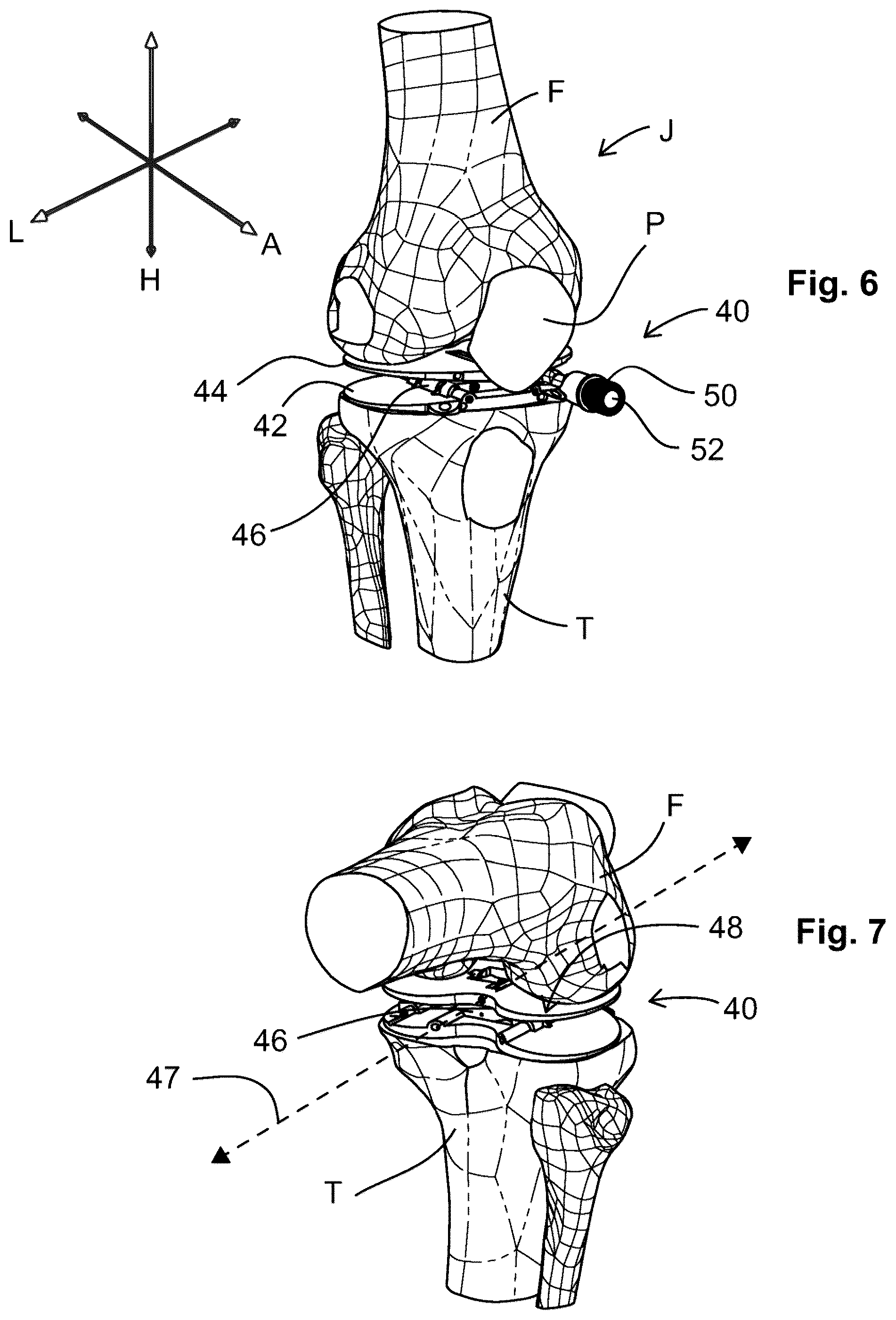 Patent US12599377 Figure 4 – Knee tensioner-balancer and method