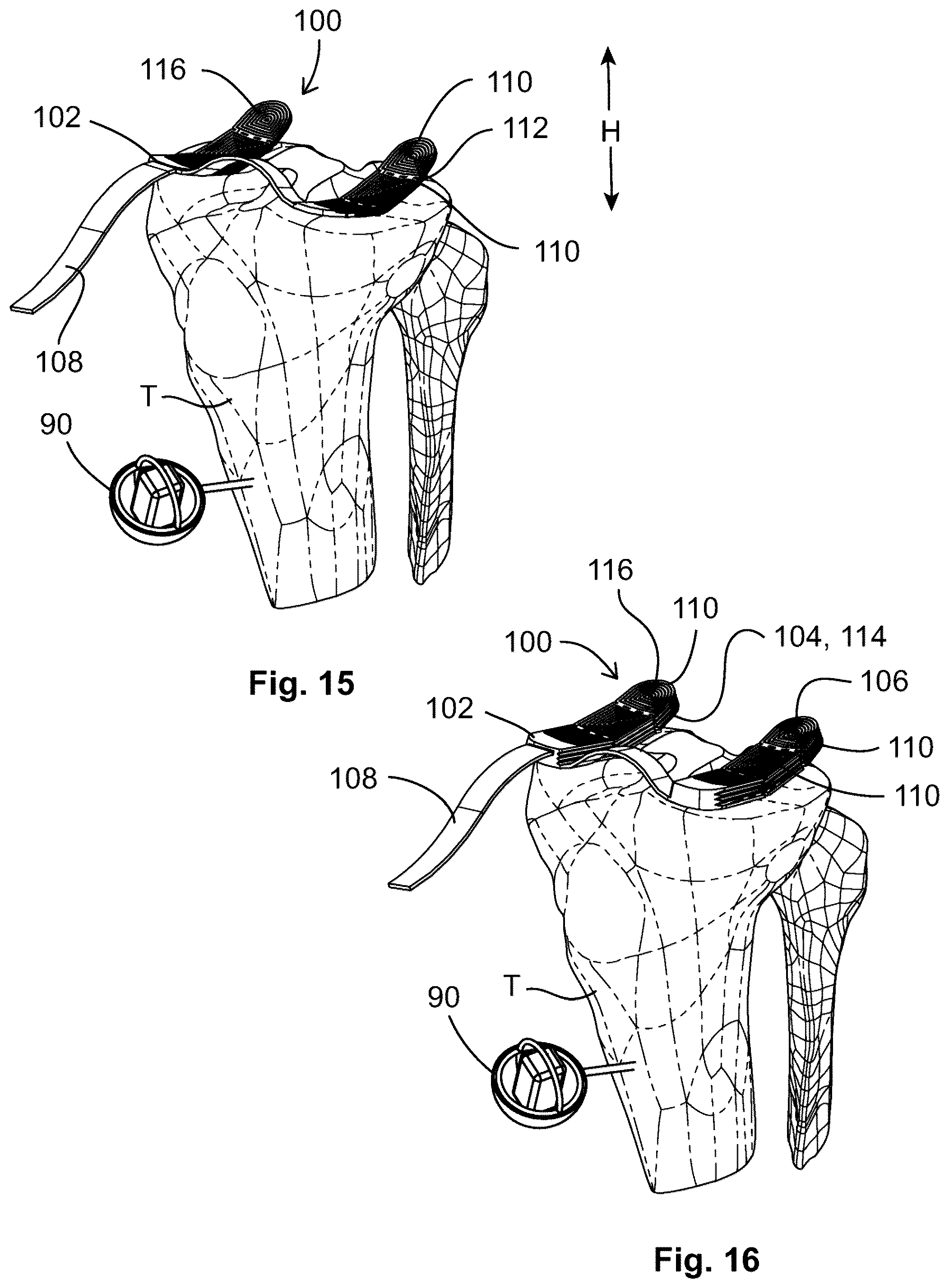 Patent US12599377 Figure 11 – Knee tensioner-balancer and method