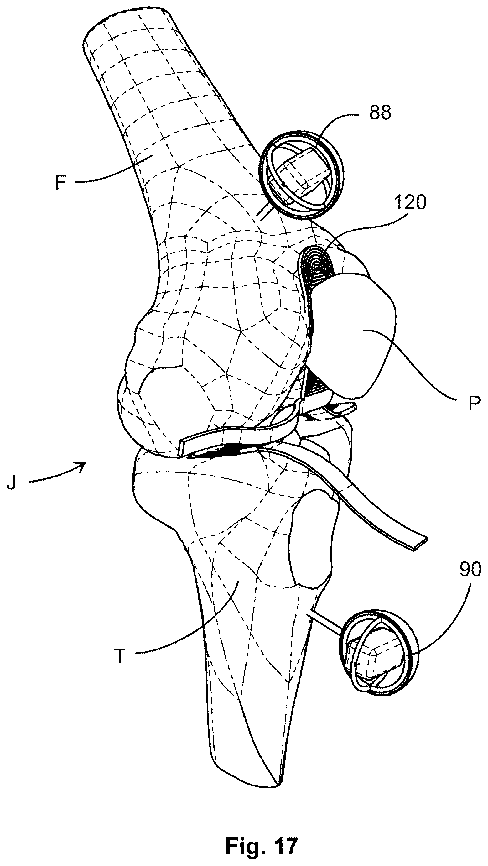 Patent US12599377 Figure 12 – Knee tensioner-balancer and method