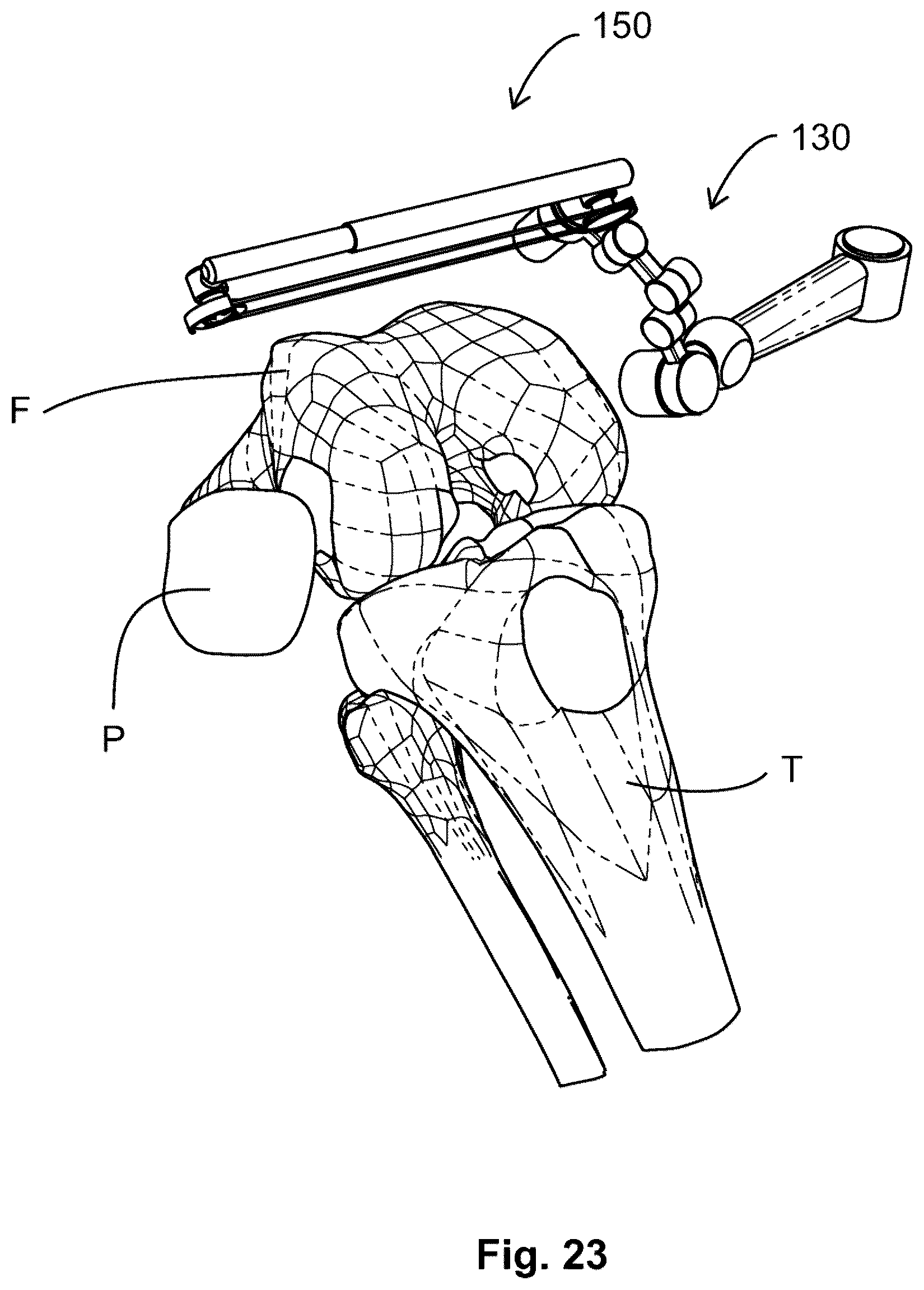 Patent US12599377 Figure 15 – Knee tensioner-balancer and method