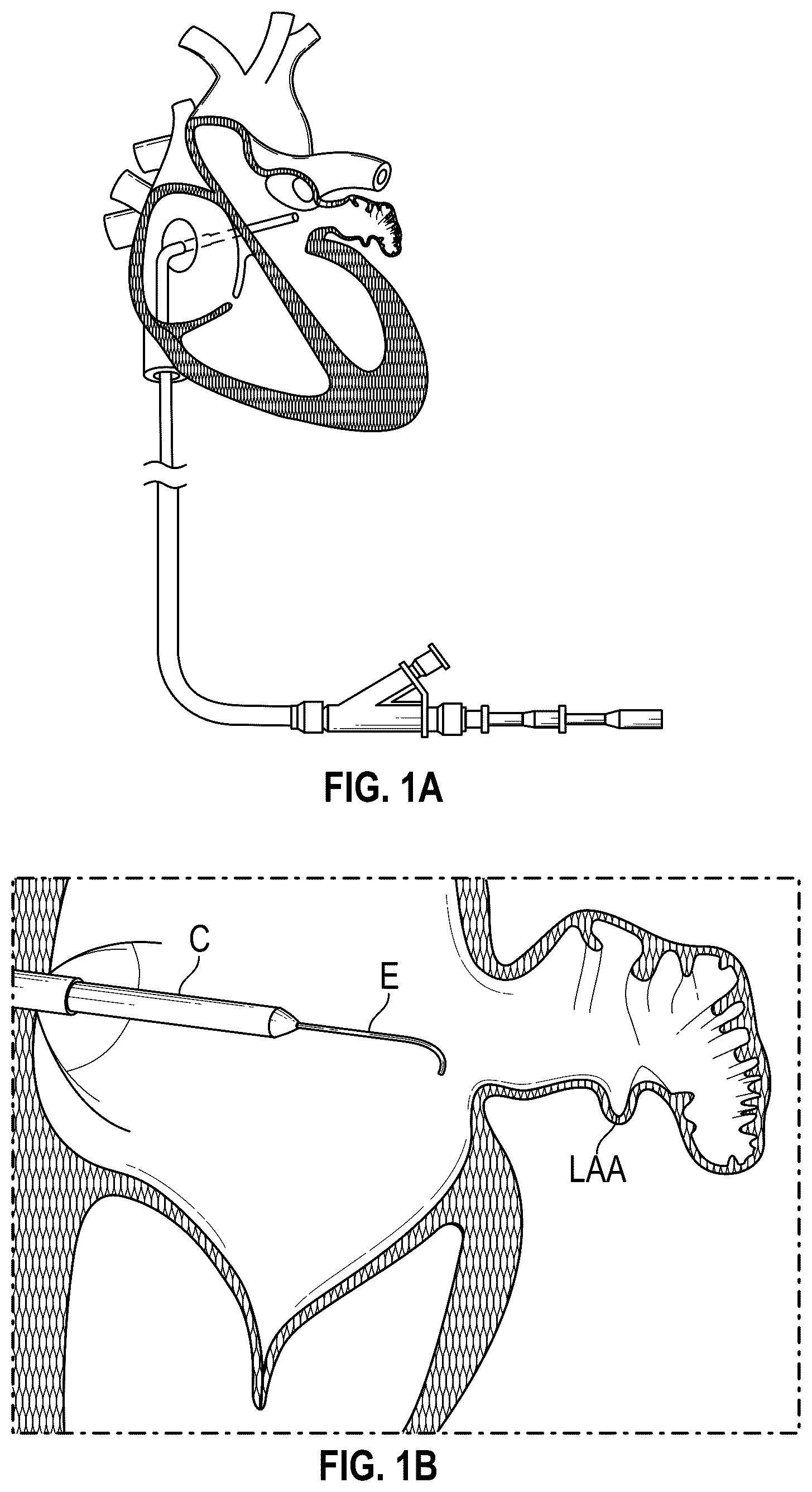 Patent US12599386 Figure 1 – Devices, systems, and methods for treating the left atrial appendage