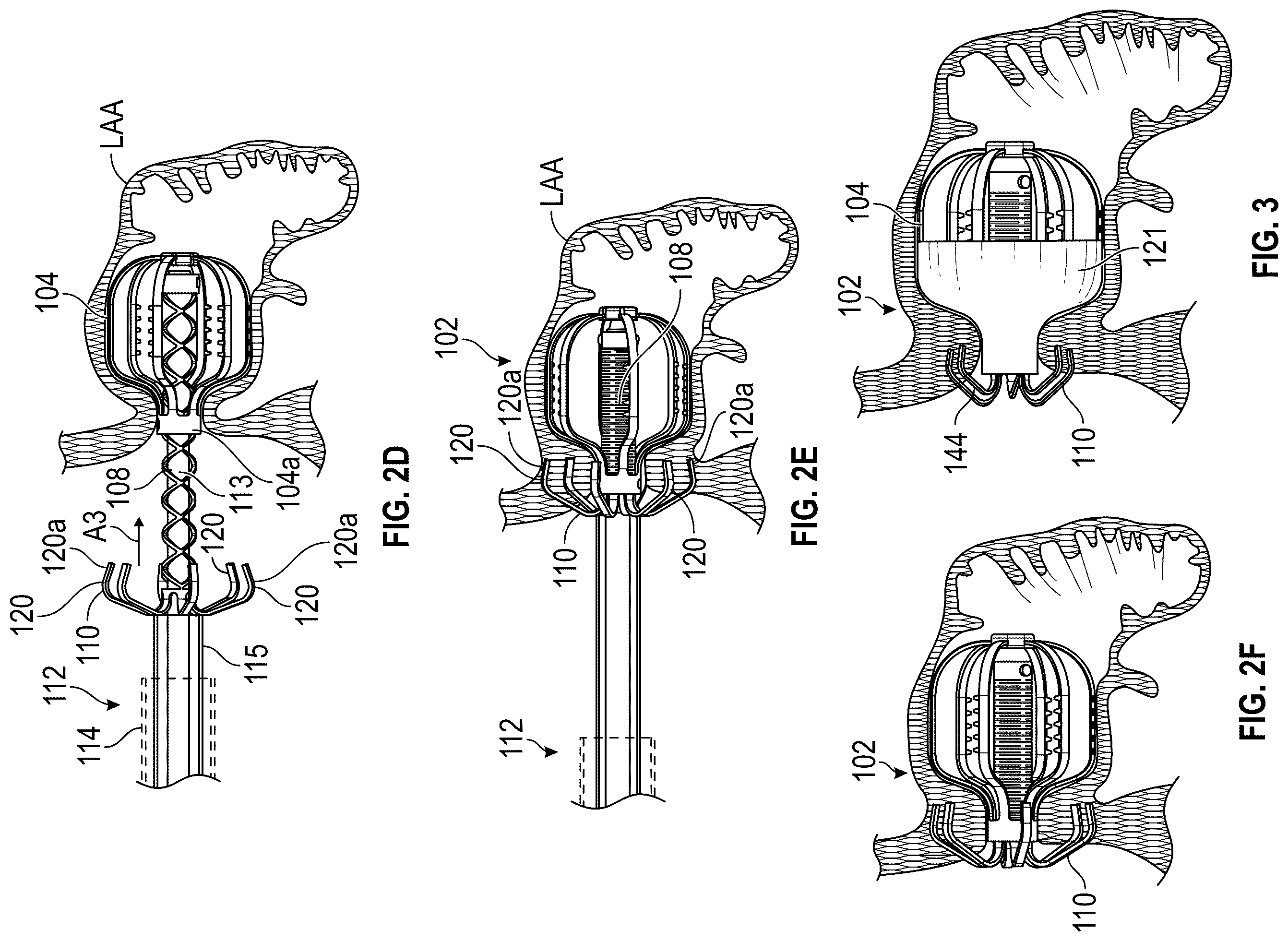 Patent US12599386 Figure 3 – Devices, systems, and methods for treating the left atrial appendage