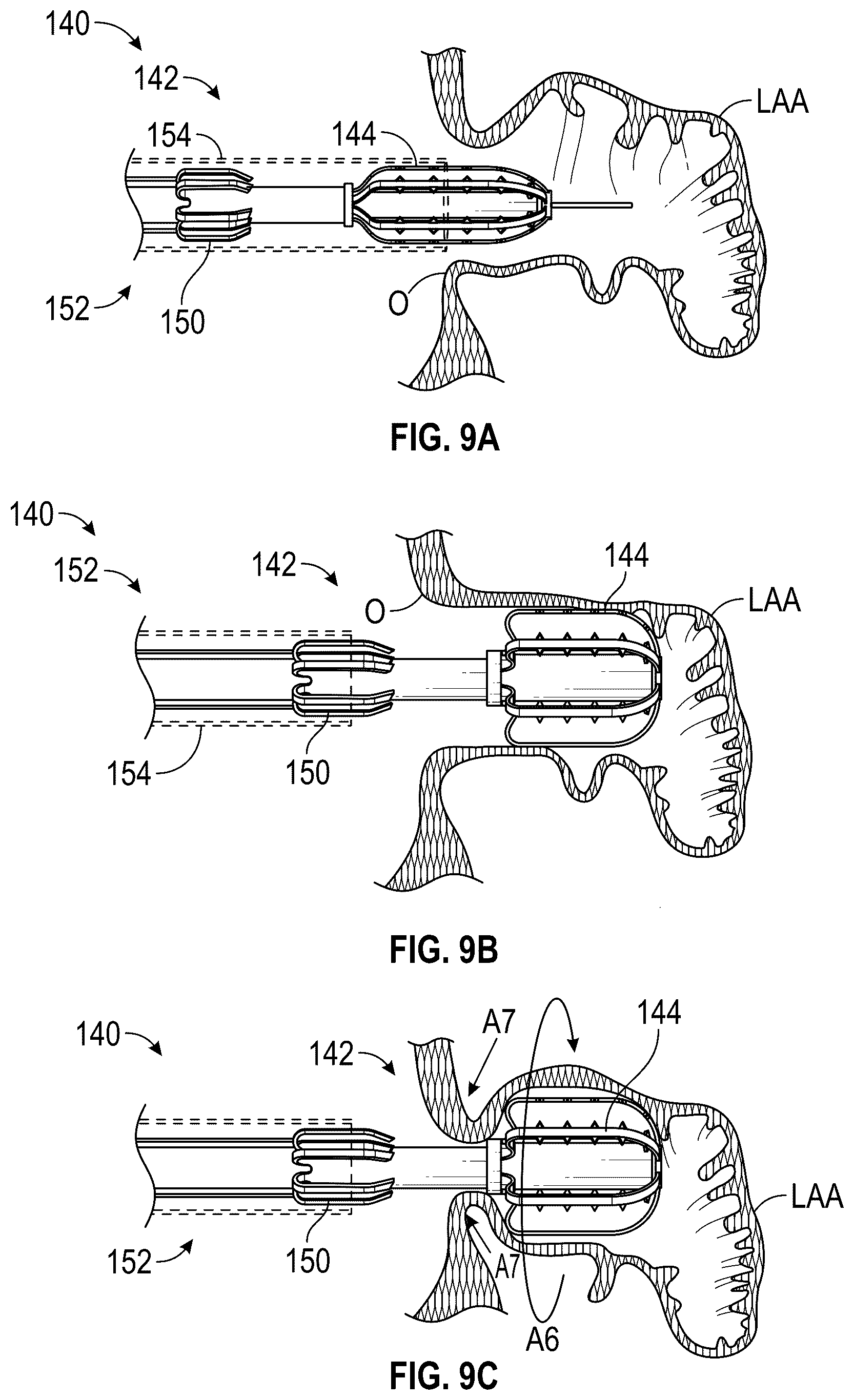 Patent US12599386 Figure 7 – Devices, systems, and methods for treating the left atrial appendage