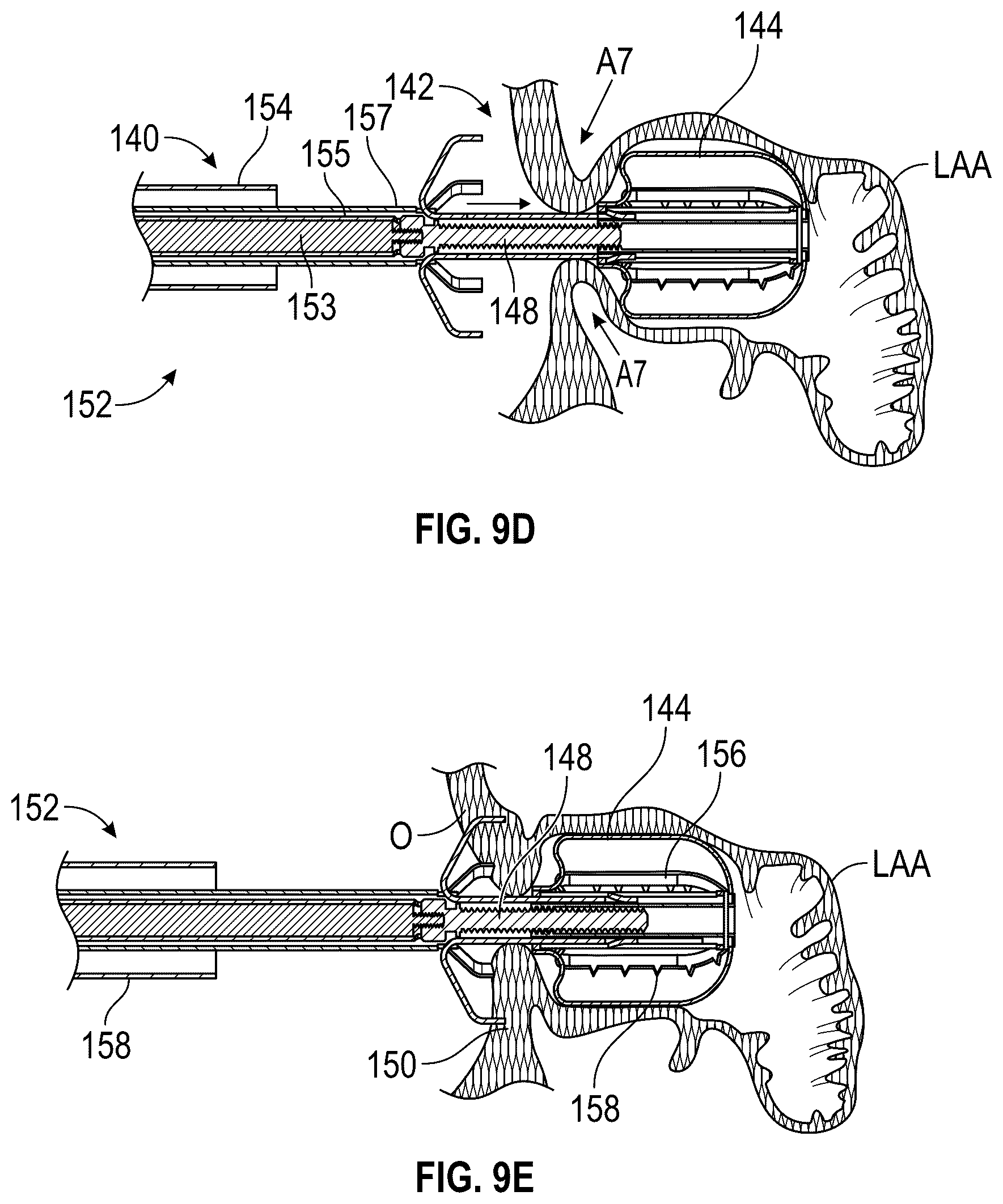 Patent US12599386 Figure 8 – Devices, systems, and methods for treating the left atrial appendage