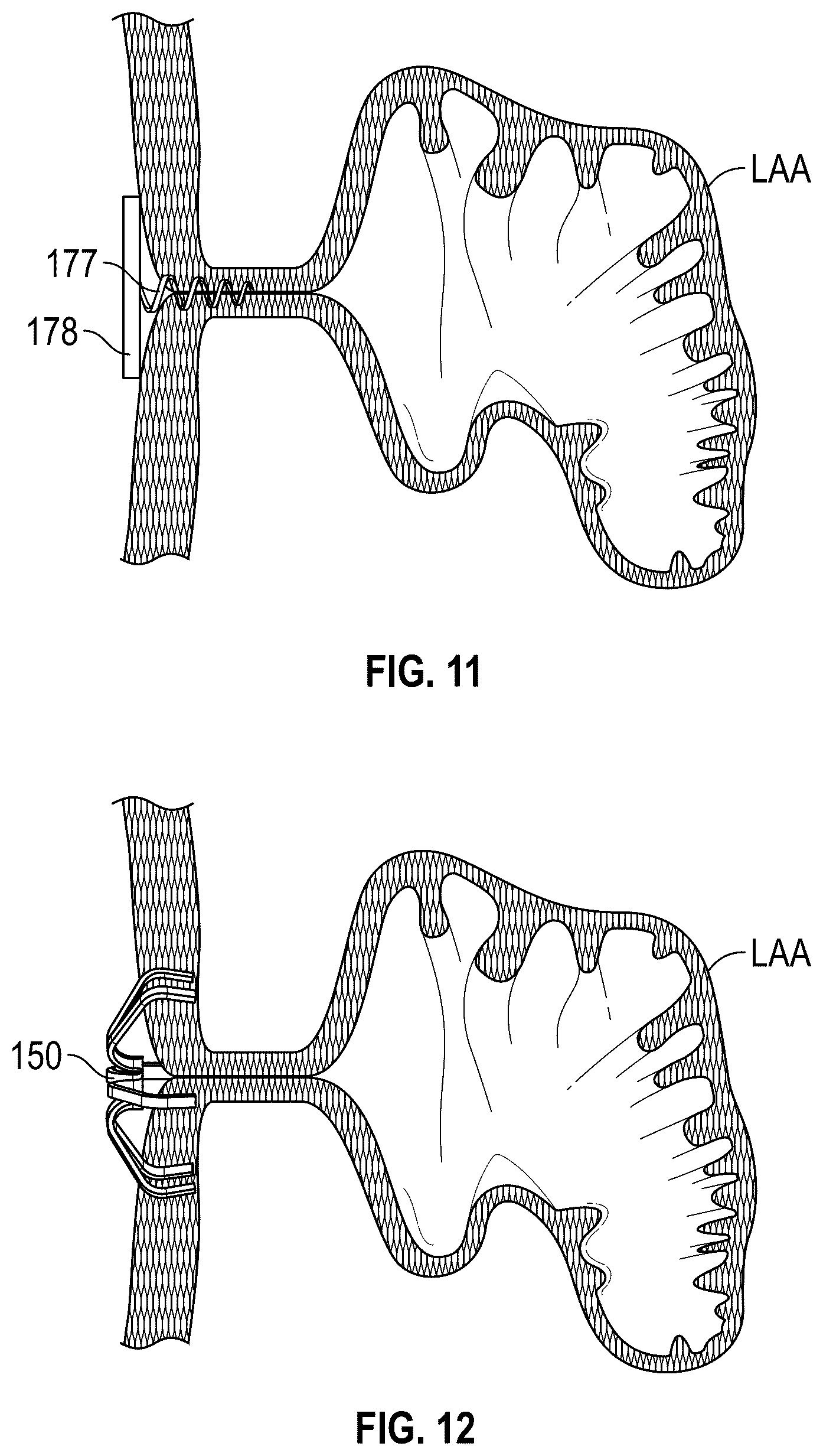 Patent US12599386 Figure 12 – Devices, systems, and methods for treating the left atrial appendage