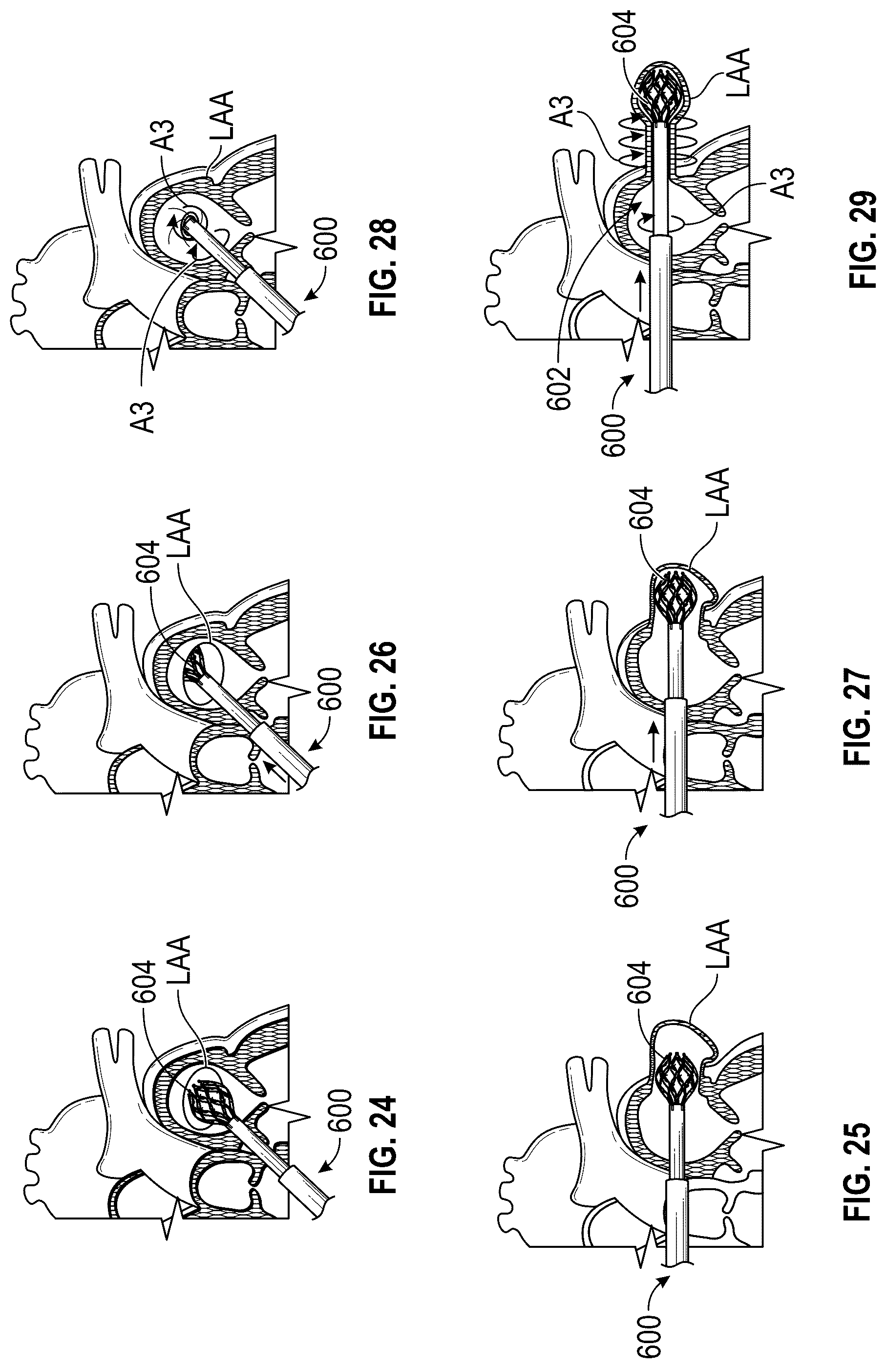 Patent US12599386 Figure 19 – Devices, systems, and methods for treating the left atrial appendage
