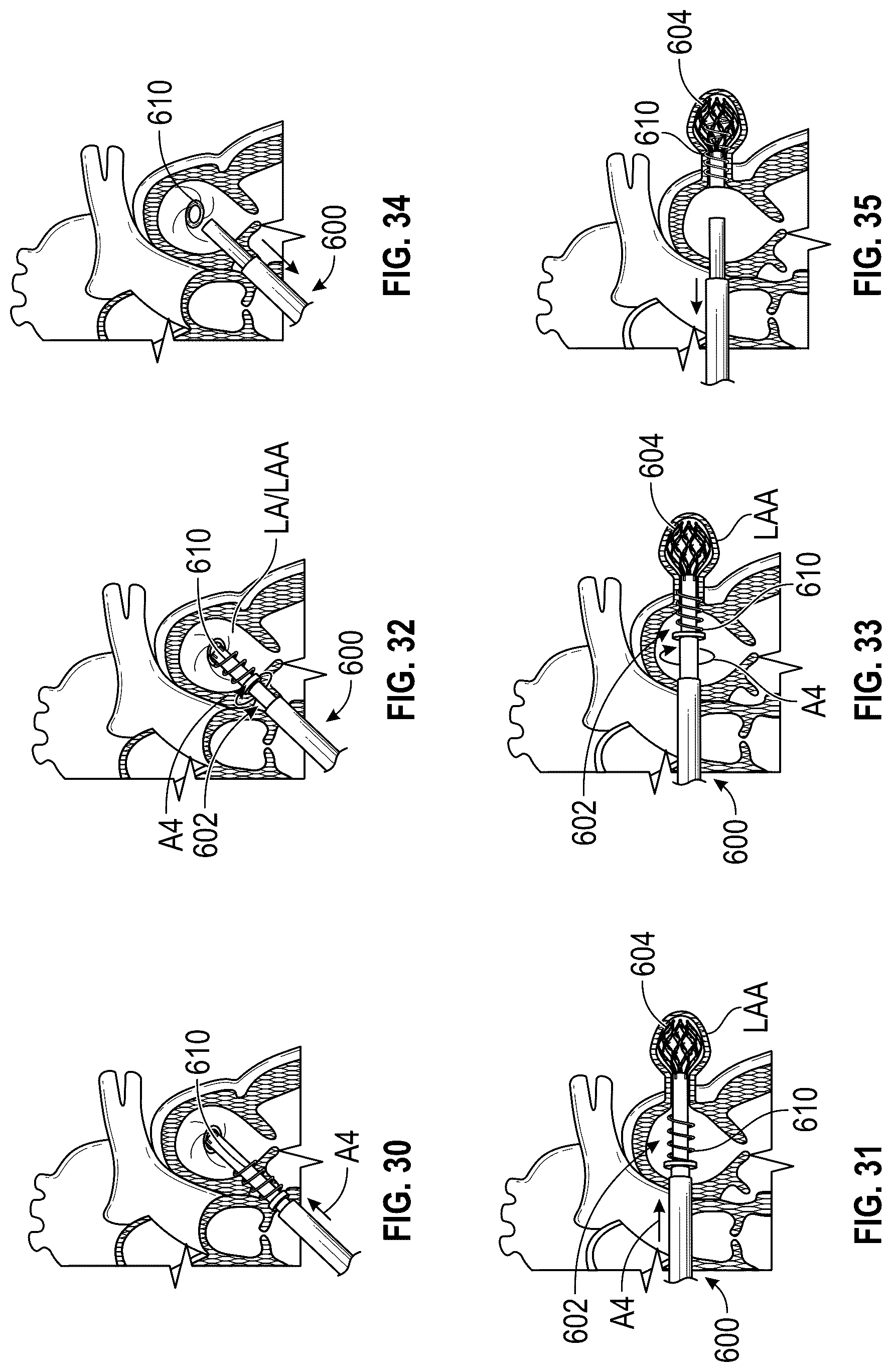 Patent US12599386 Figure 20 – Devices, systems, and methods for treating the left atrial appendage