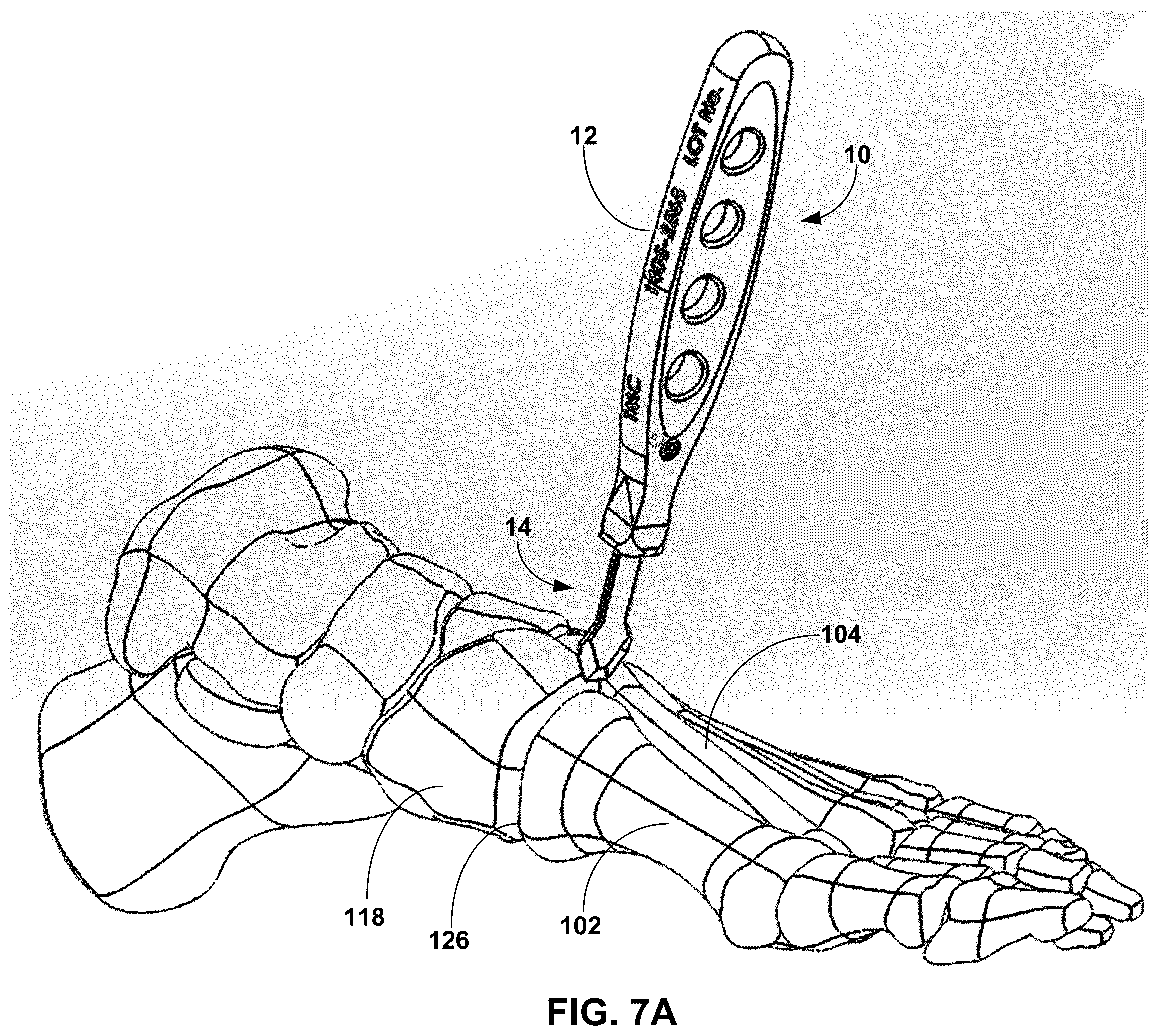 Patent US12599389 Figure 9 – Multi-sided cutting instrument for mobilizing small bones in the foot