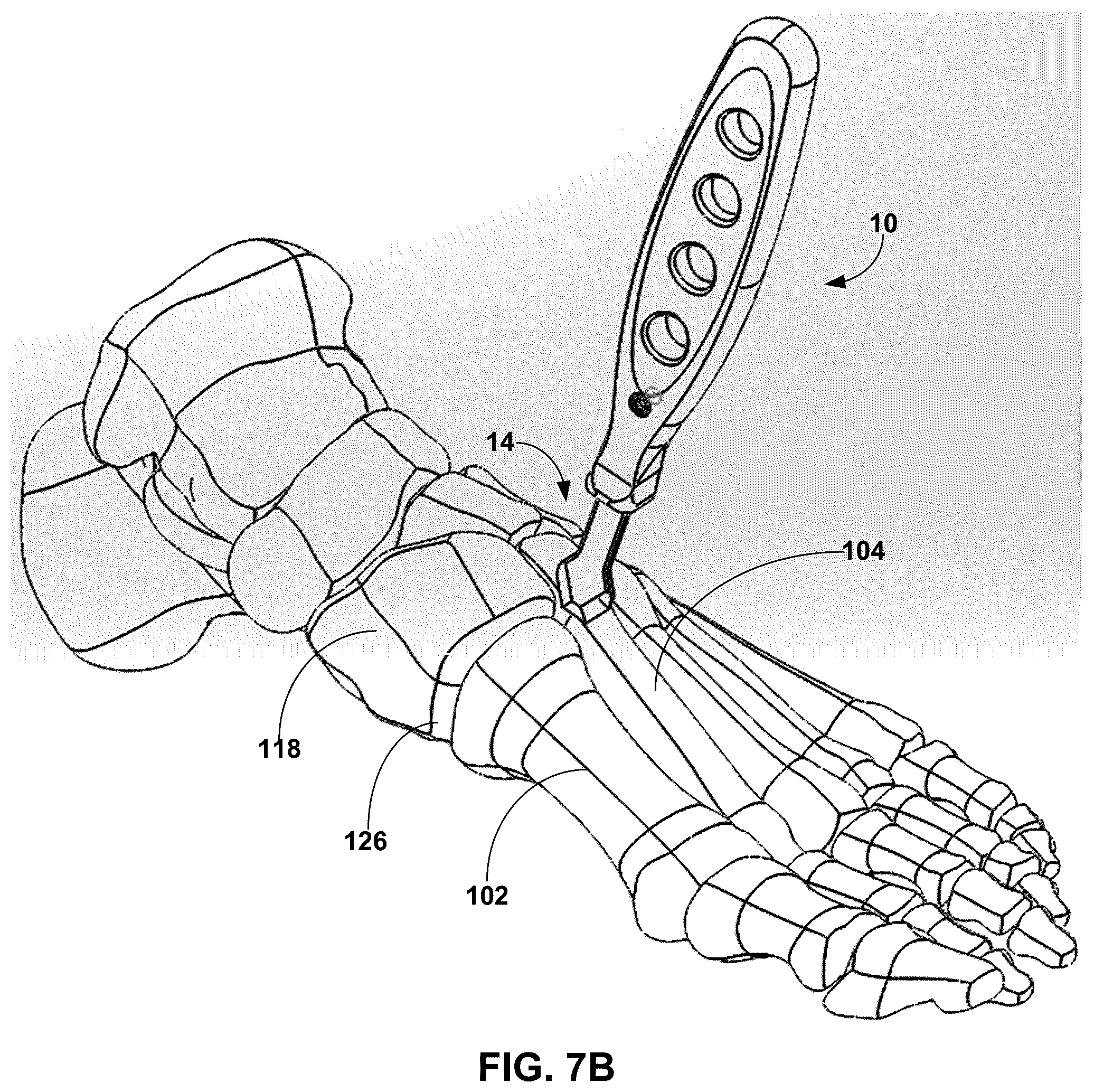 Patent US12599389 Figure 10 – Multi-sided cutting instrument for mobilizing small bones in the foot