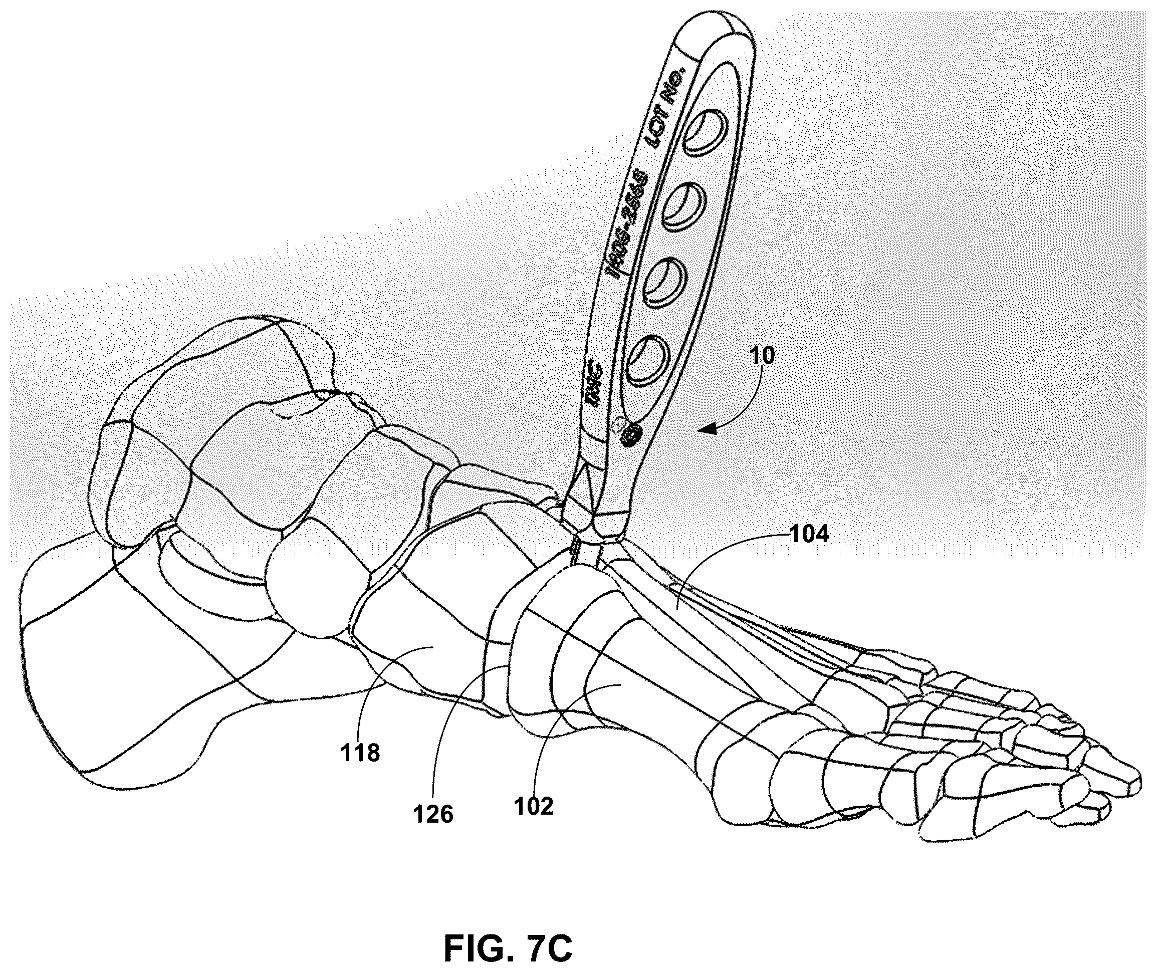 Patent US12599389 Figure 11 – Multi-sided cutting instrument for mobilizing small bones in the foot