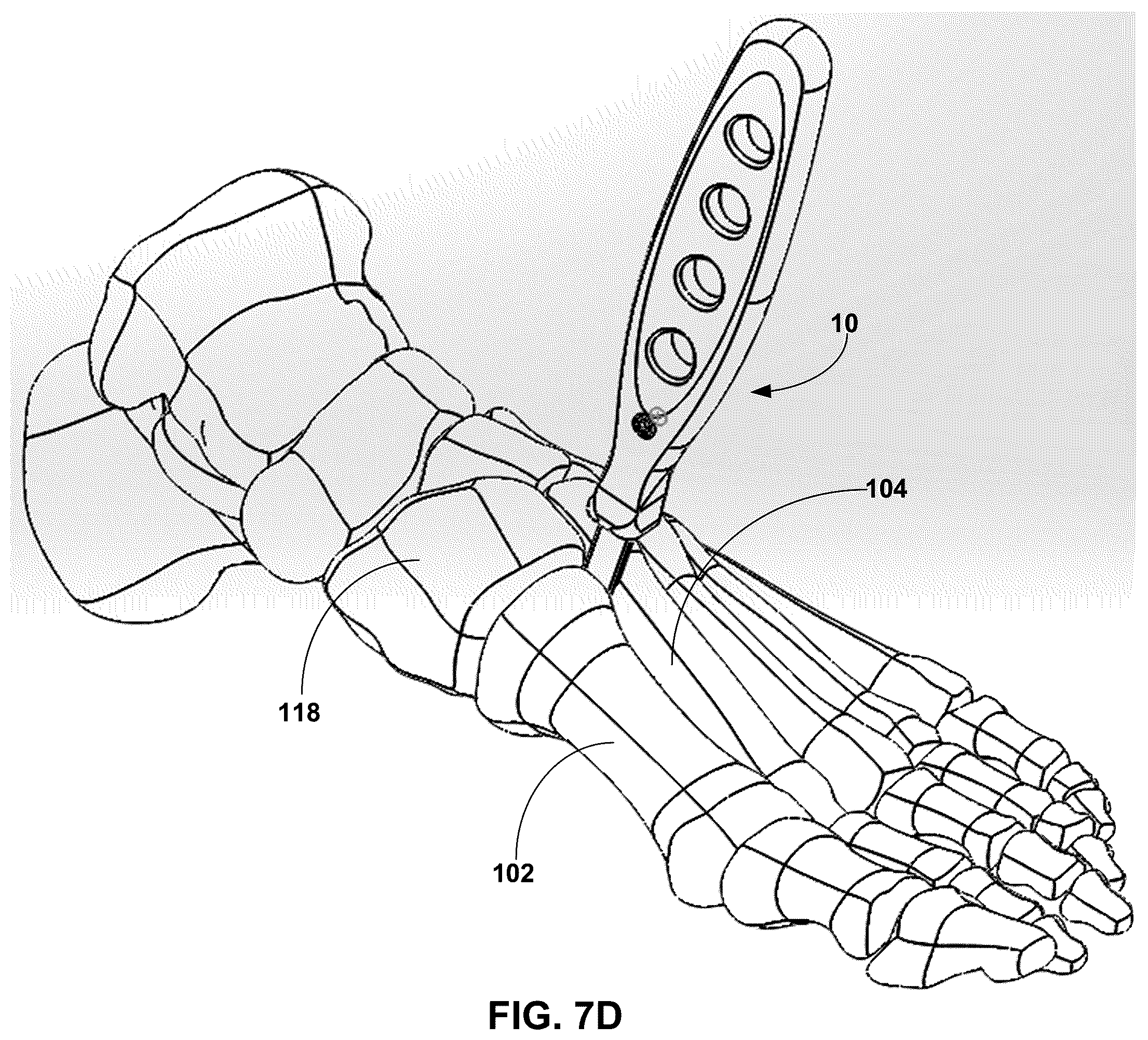 Patent US12599389 Figure 12 – Multi-sided cutting instrument for mobilizing small bones in the foot