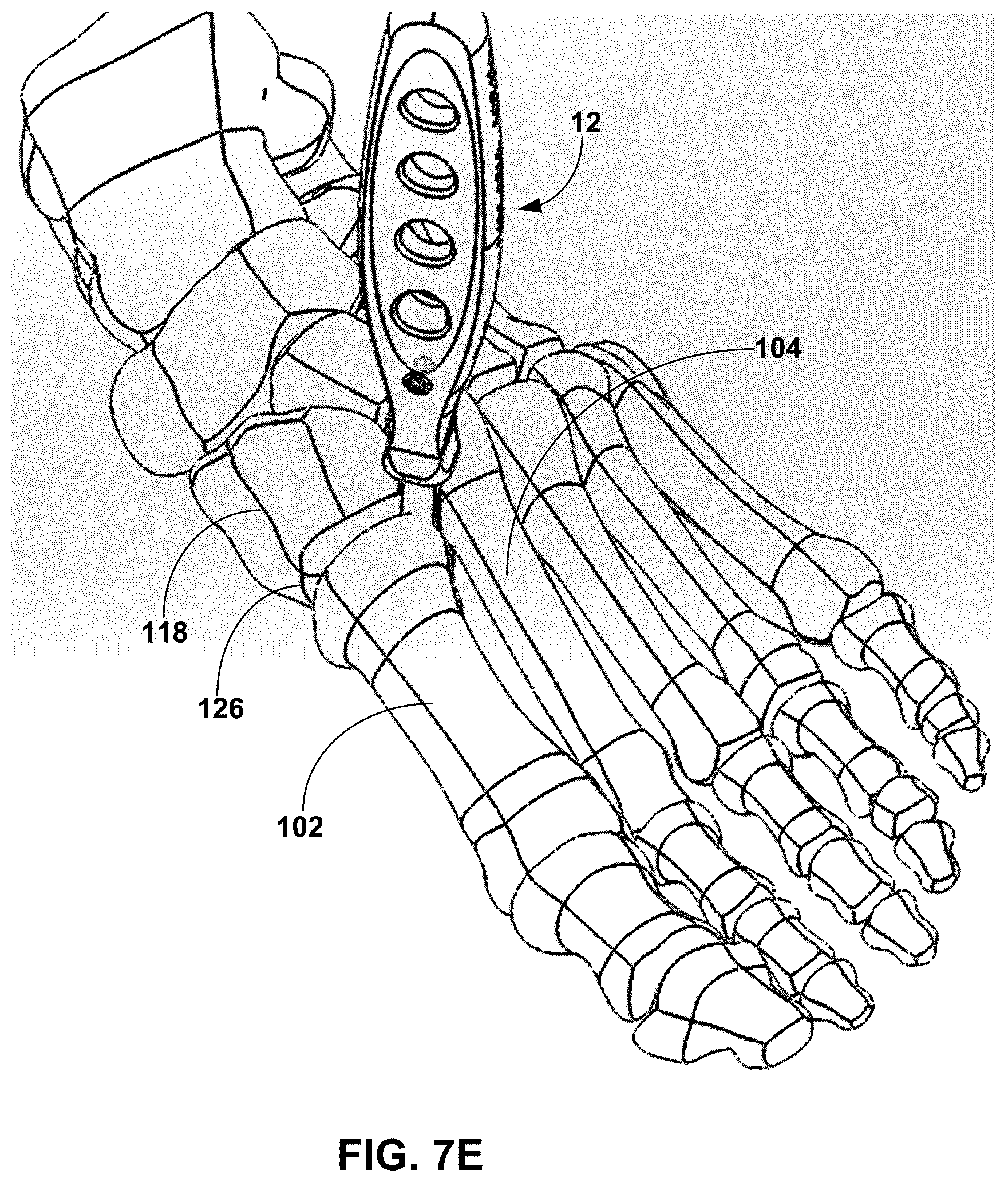Patent US12599389 Figure 13 – Multi-sided cutting instrument for mobilizing small bones in the foot