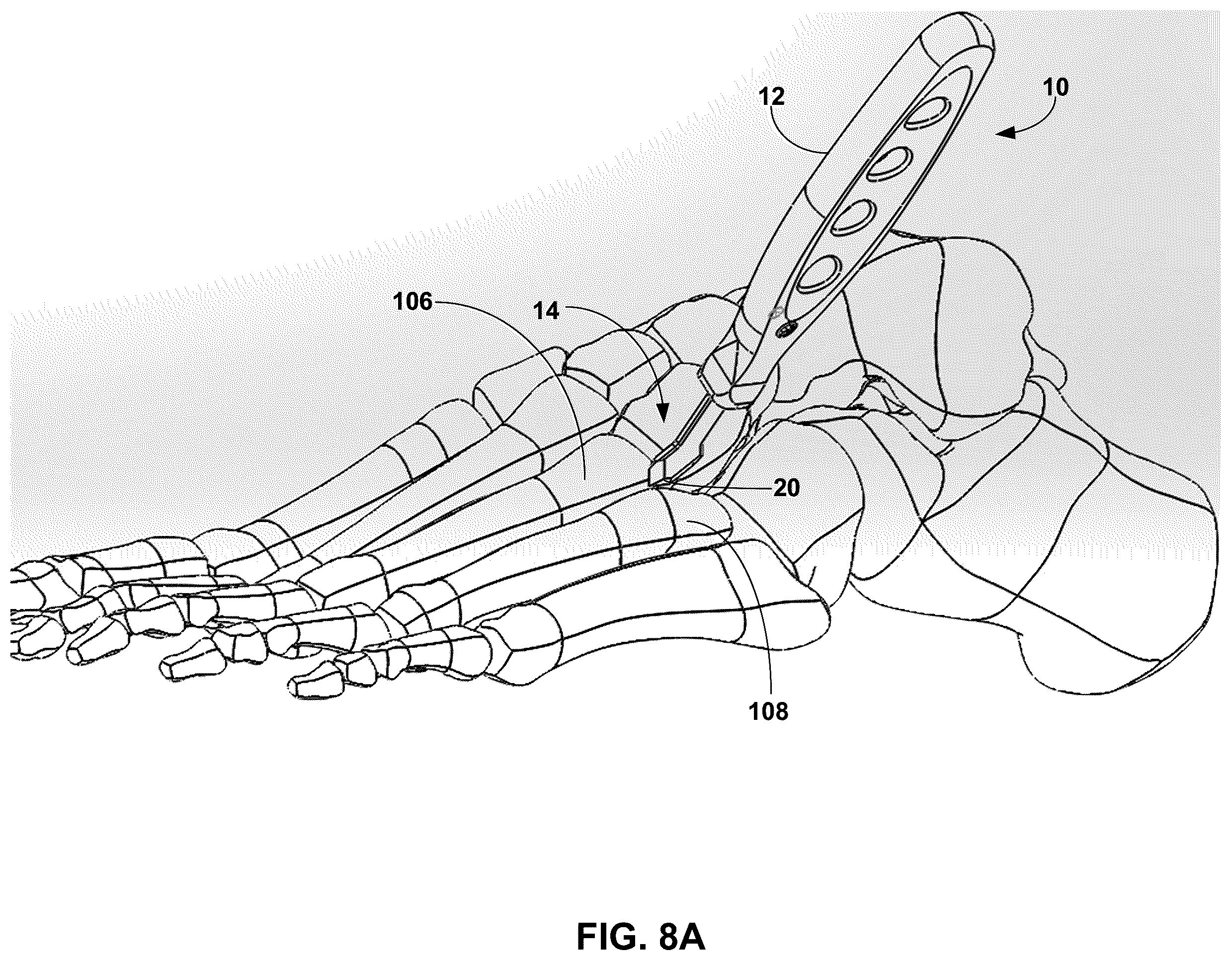 Patent US12599389 Figure 14 – Multi-sided cutting instrument for mobilizing small bones in the foot