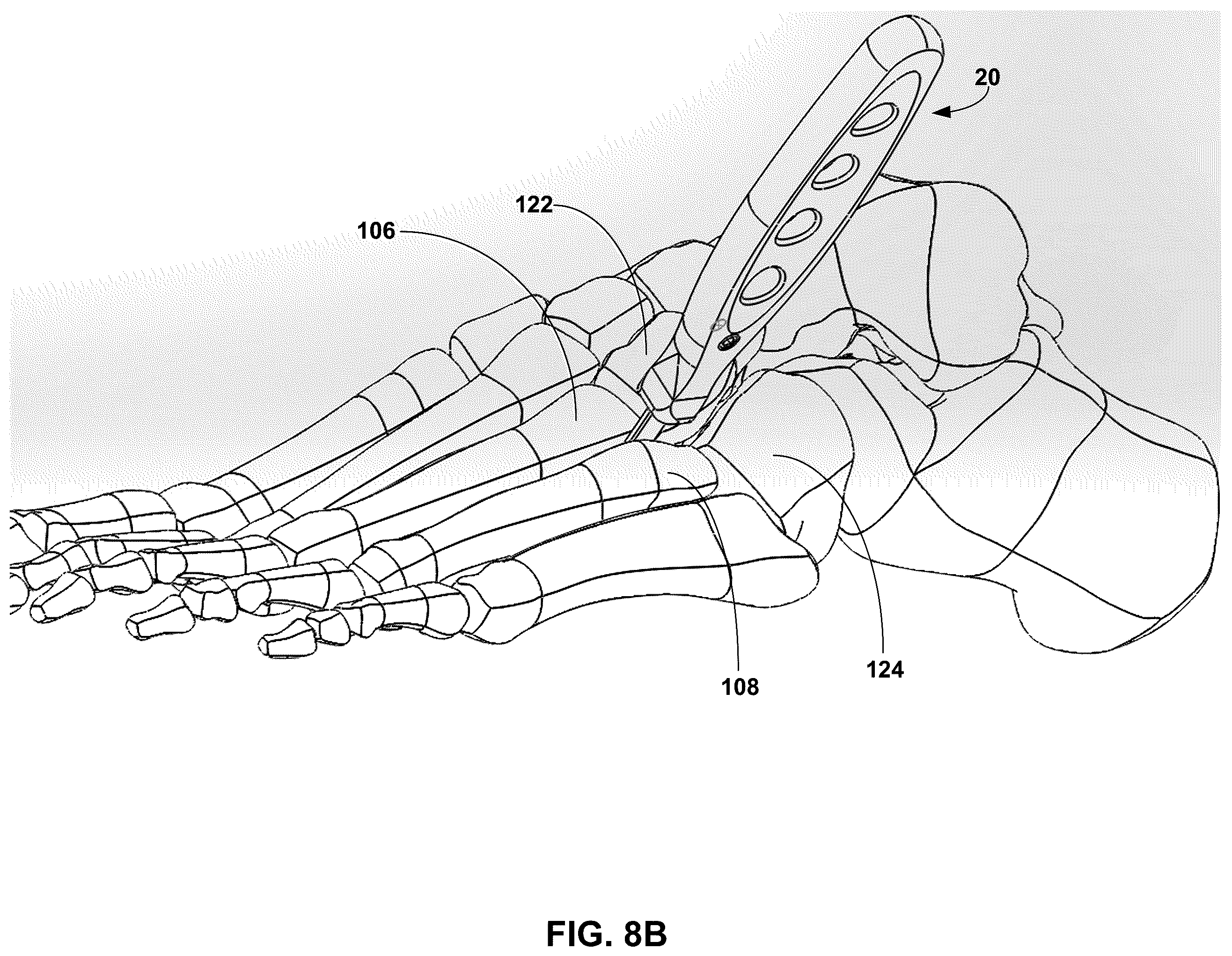 Patent US12599389 Figure 15 – Multi-sided cutting instrument for mobilizing small bones in the foot