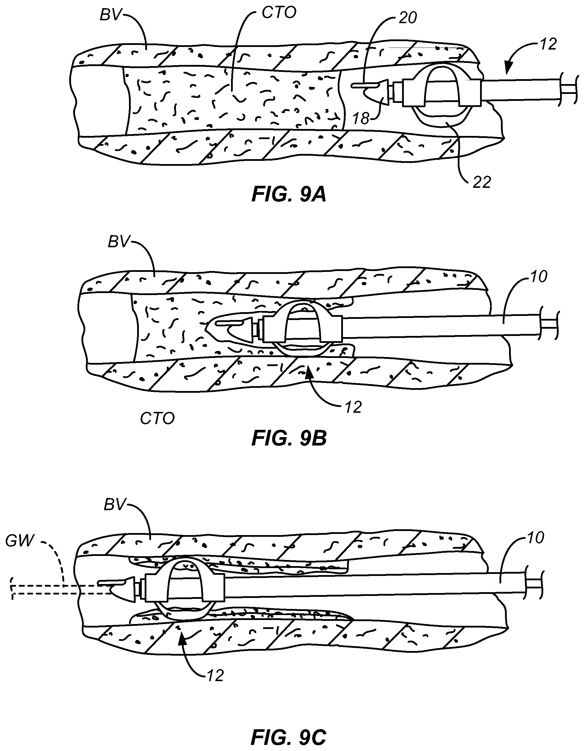Patent US12599398 Figure 7 – Device and method for centering and crossing a vascular occlusion