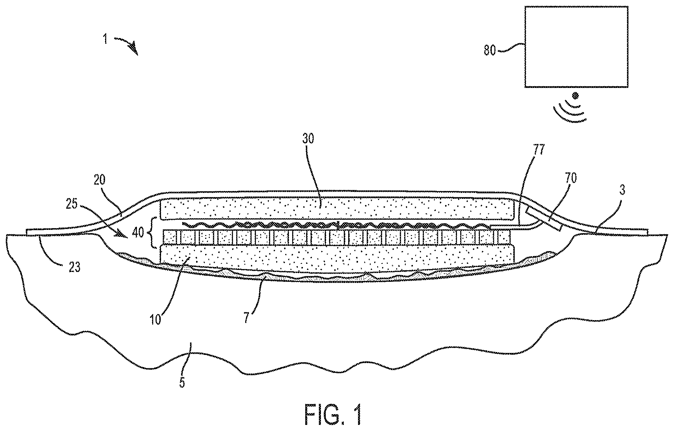 Patent US12599399 Figure 1 – Method and system for providing active tissue site debridement