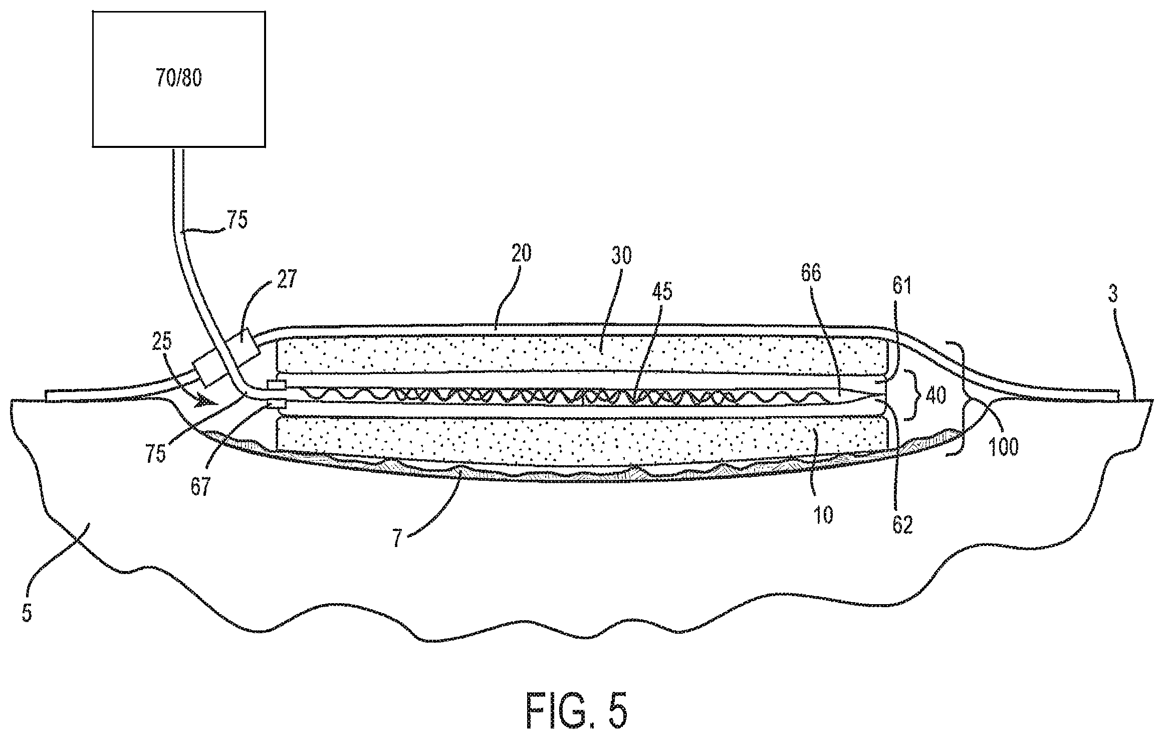 Patent US12599399 Figure 5 – Method and system for providing active tissue site debridement