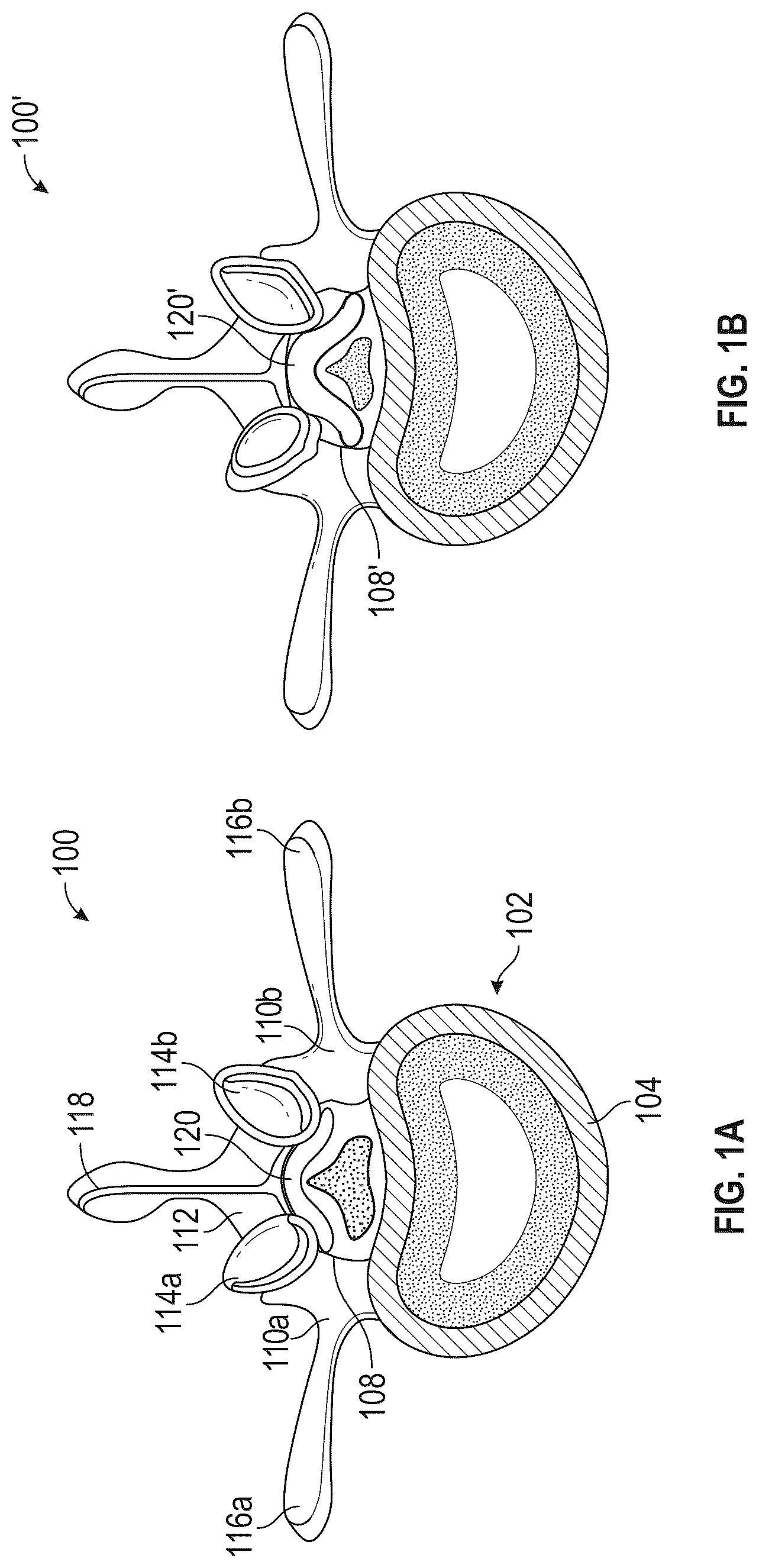 Patent US12599400 Figure 1 – Surgical kit for spinal decompression to treat spinal stenosis