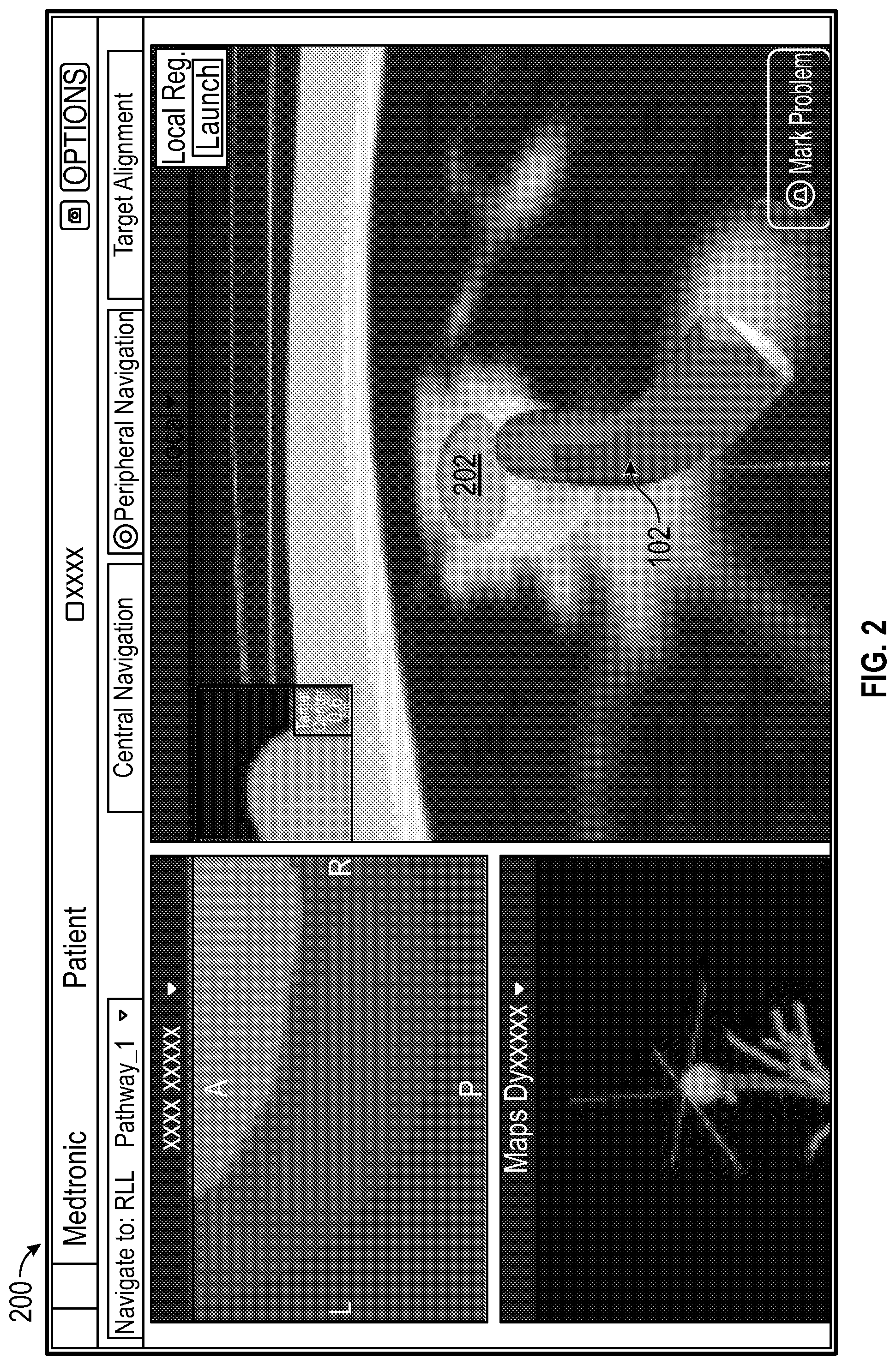 Patent US12599402 Figure 2 – Deflectable pulmonary access tool