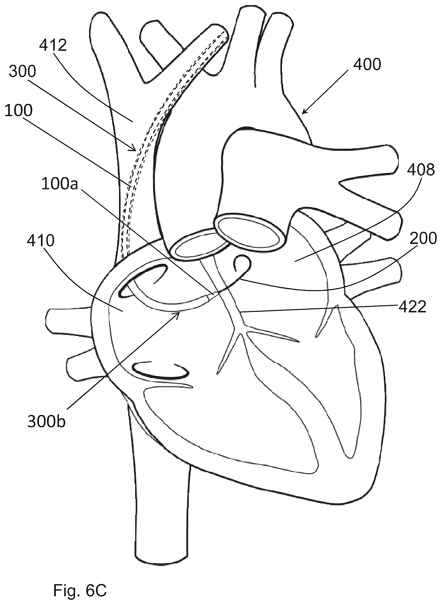 Patent US12599406 Figure 17 – Methods and devices for puncturing tissue