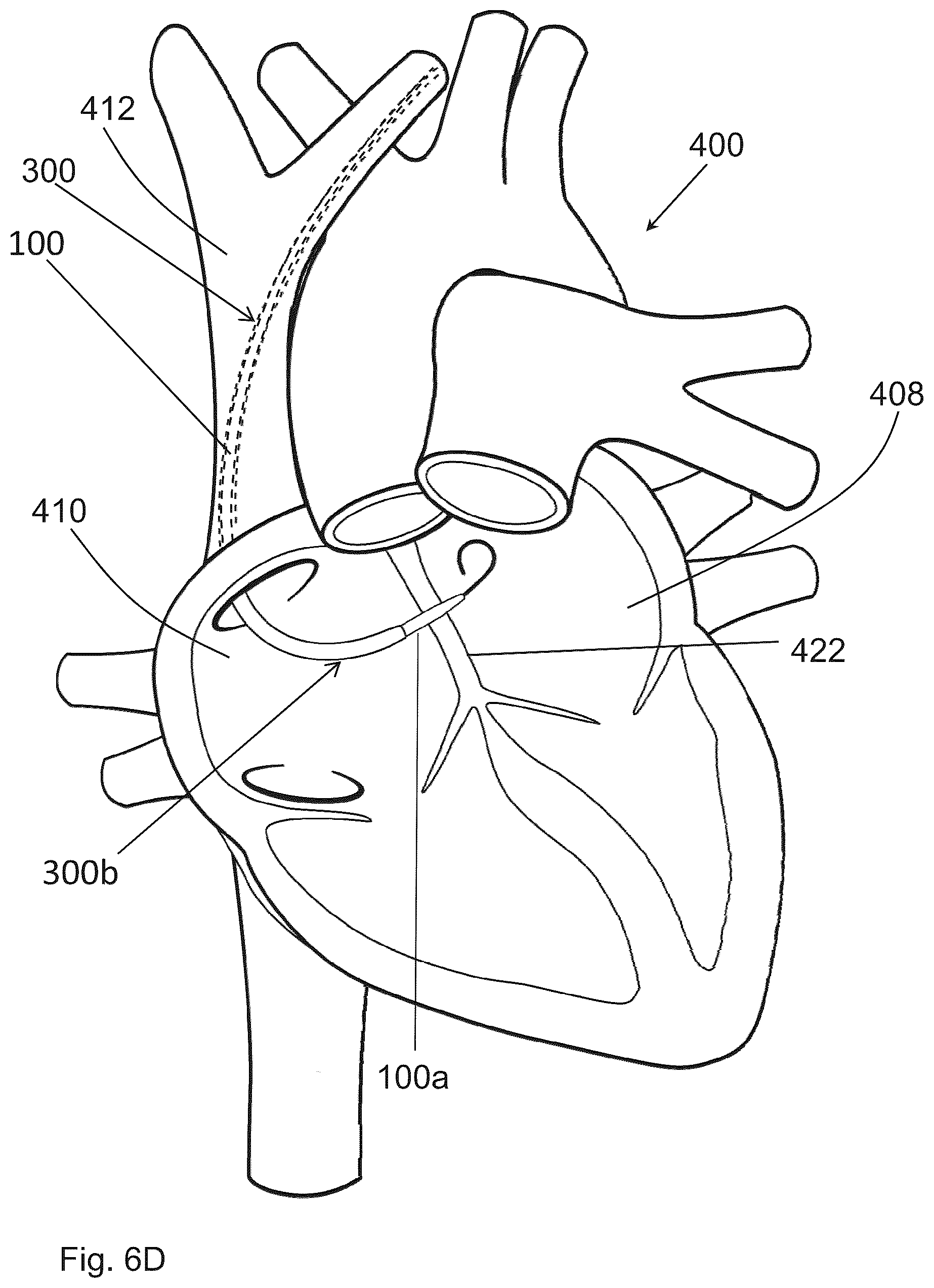 Patent US12599406 Figure 18 – Methods and devices for puncturing tissue