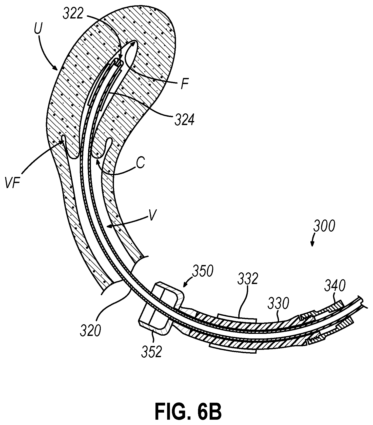 Patent US12599407 Figure 5 – System and method to measure uterine wall thickness