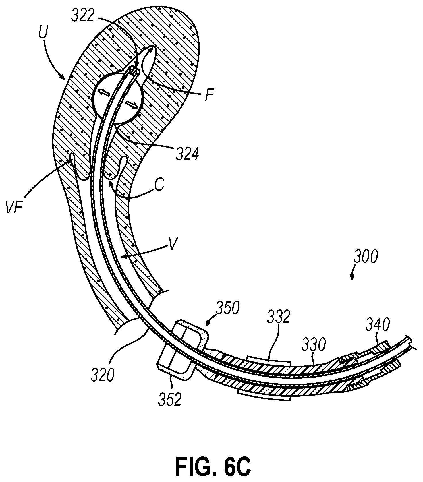 Patent US12599407 Figure 6 – System and method to measure uterine wall thickness