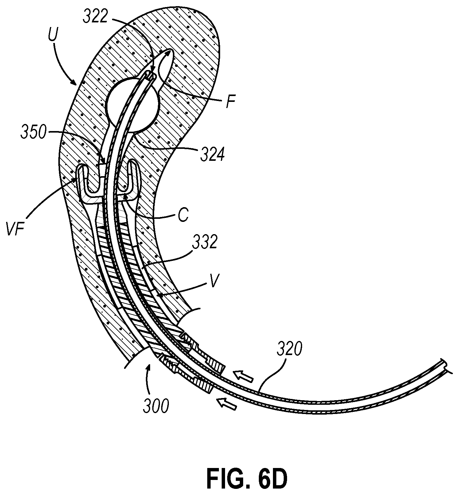 Patent US12599407 Figure 7 – System and method to measure uterine wall thickness