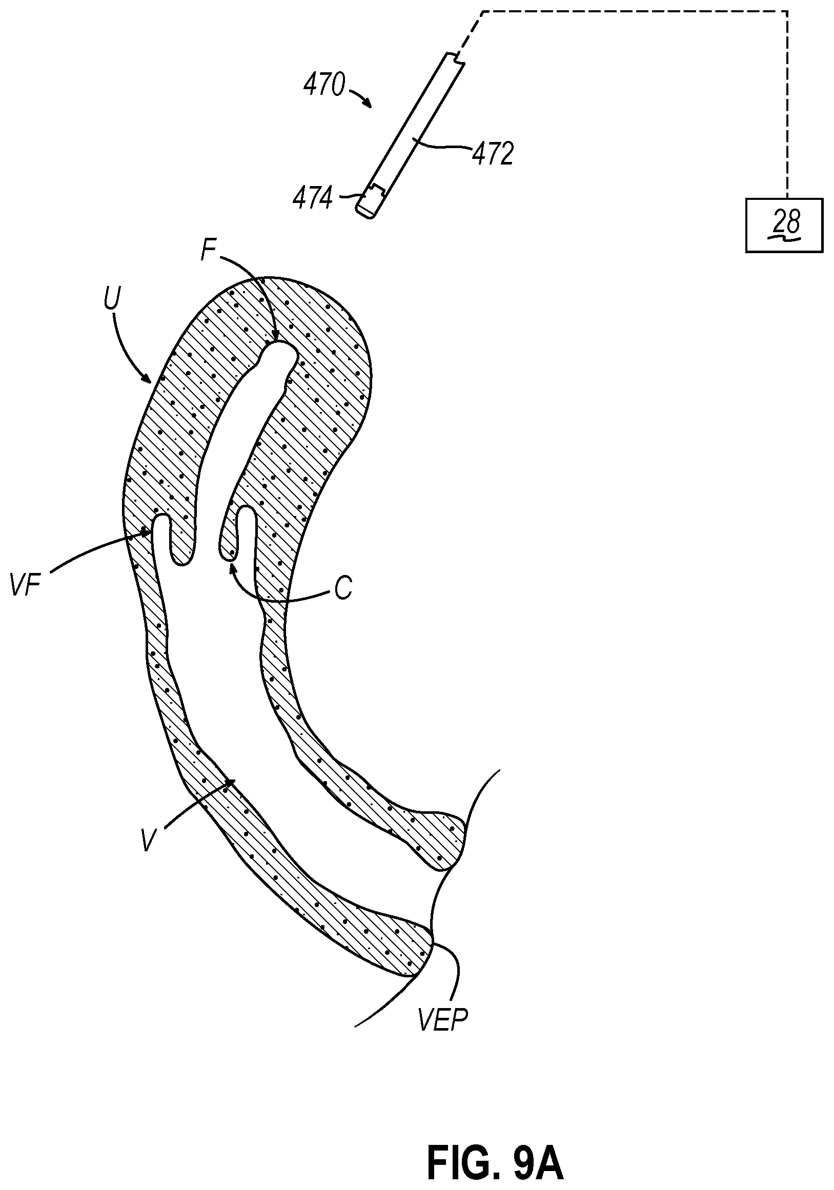 Patent US12599407 Figure 12 – System and method to measure uterine wall thickness