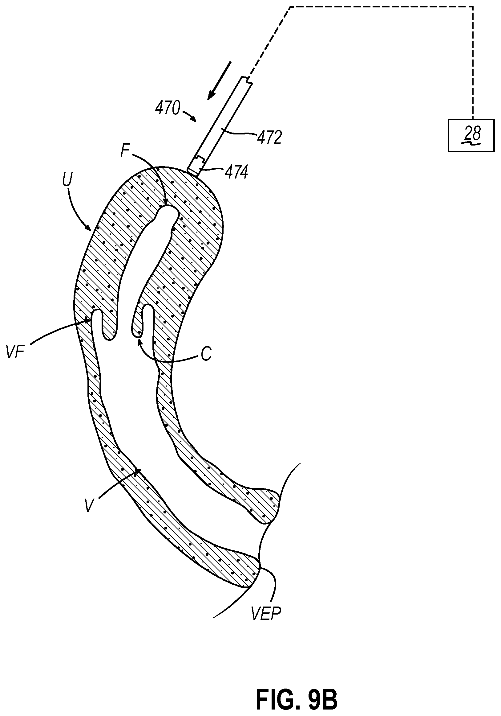 Patent US12599407 Figure 13 – System and method to measure uterine wall thickness