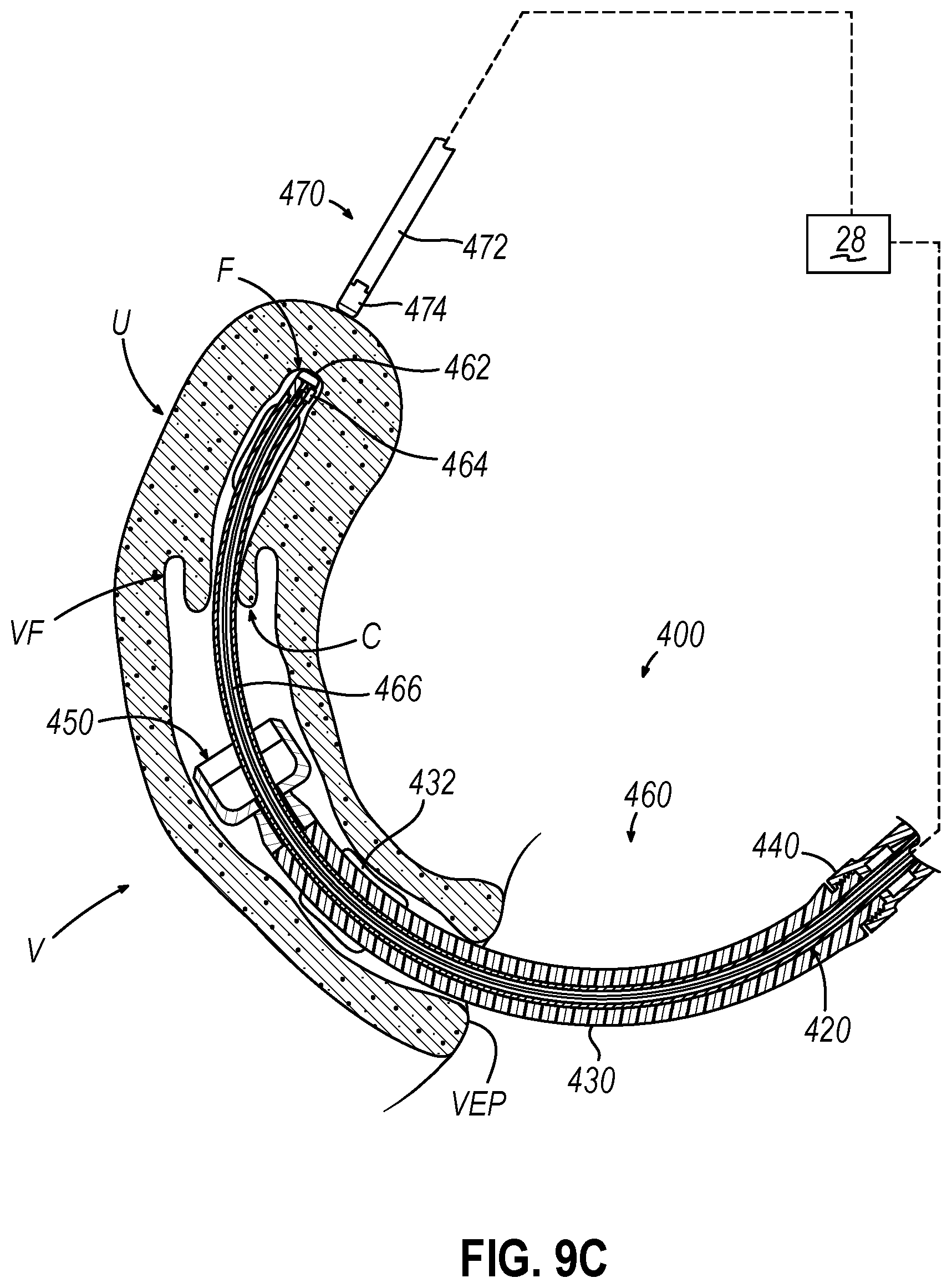 Patent US12599407 Figure 14 – System and method to measure uterine wall thickness